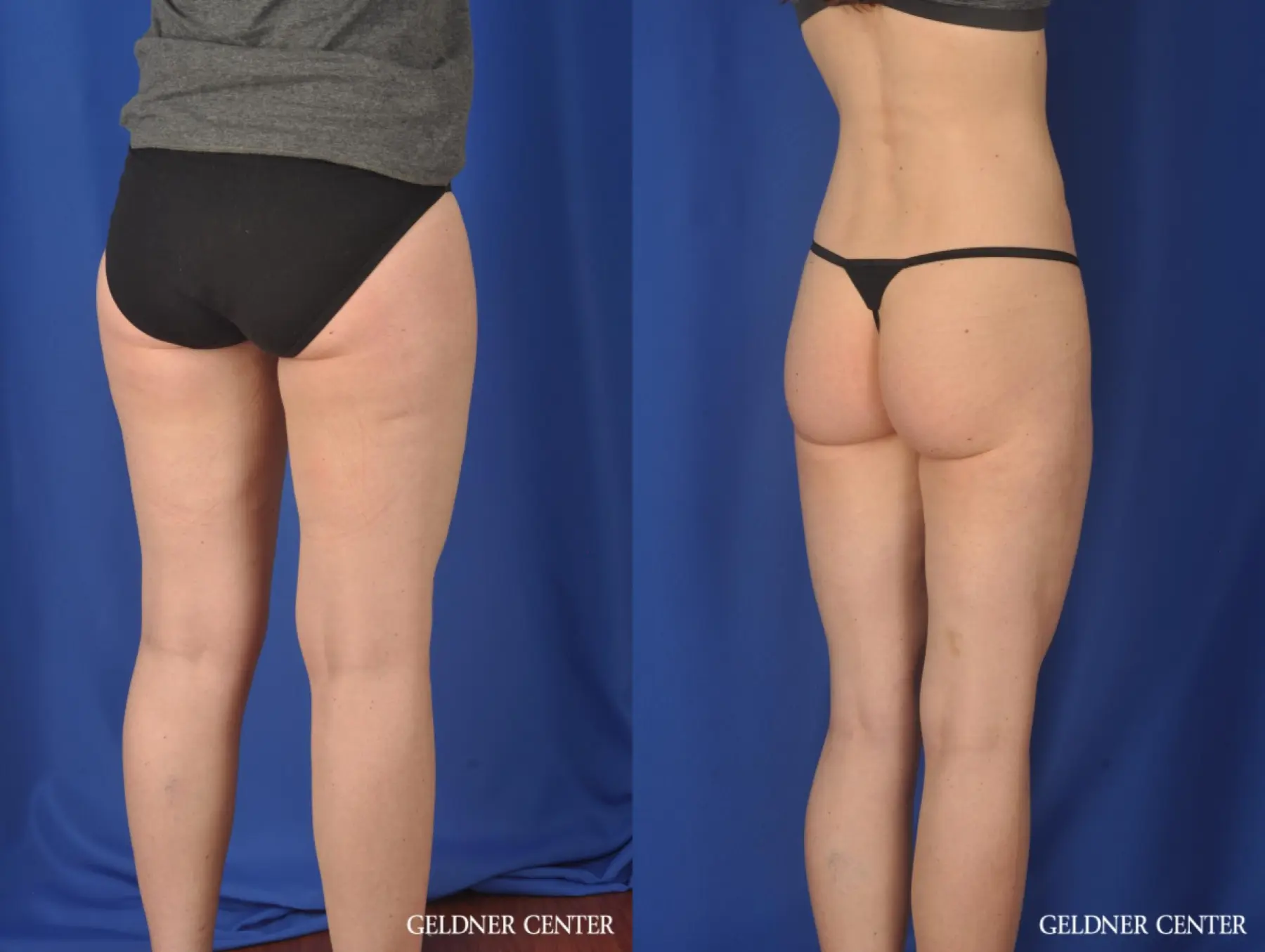 Liposuction: Patient 36 - Before and After 4