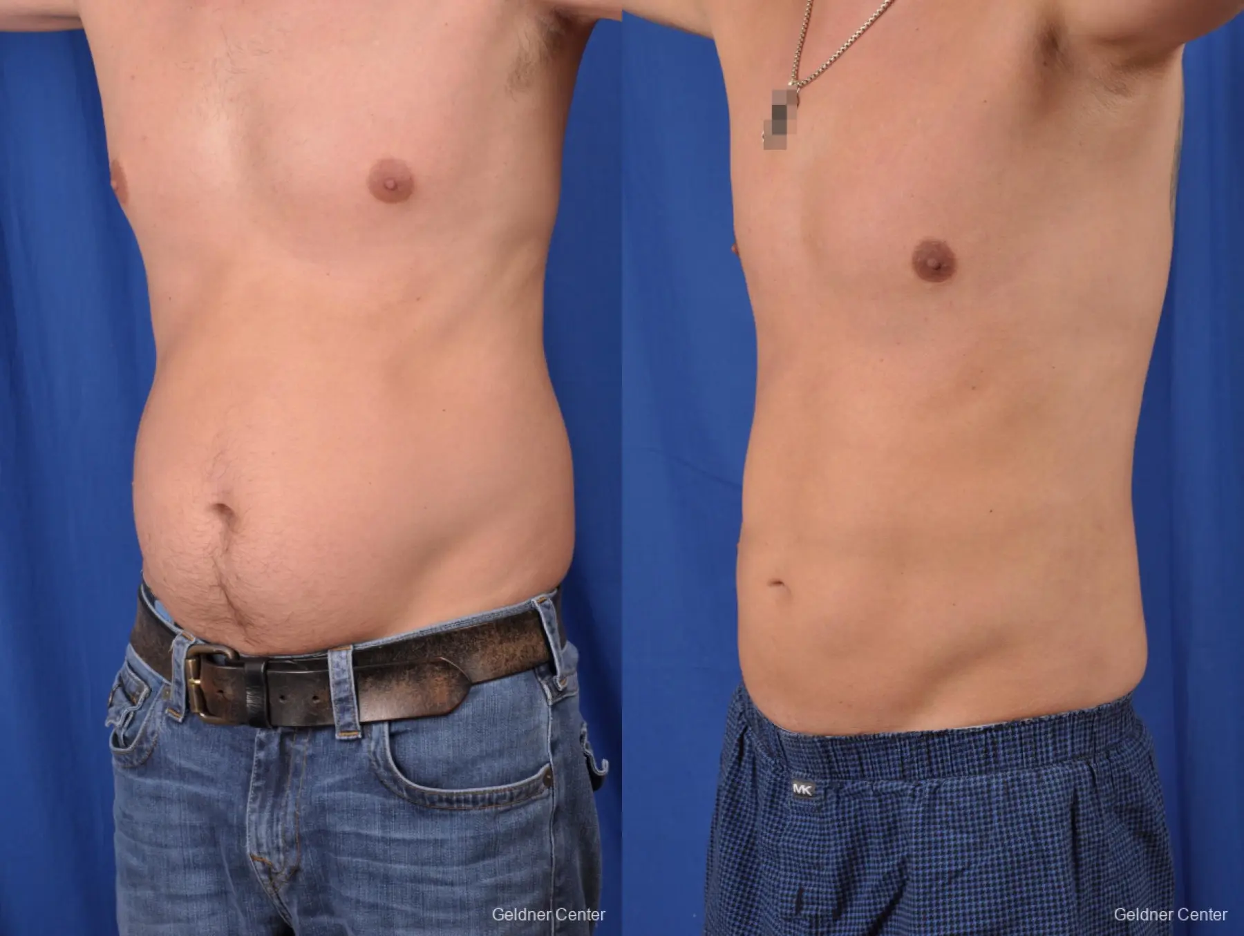 Liposuction For Men: Patient 6 - Before and After 5