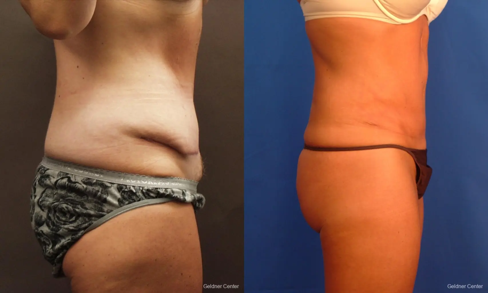 Liposuction: Patient 16 - Before and After 2