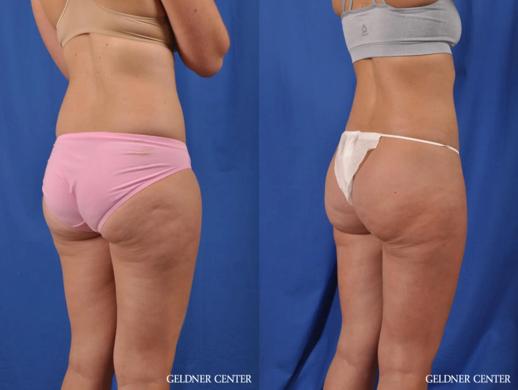 Liposuction: Patient 38 - Before and After 4