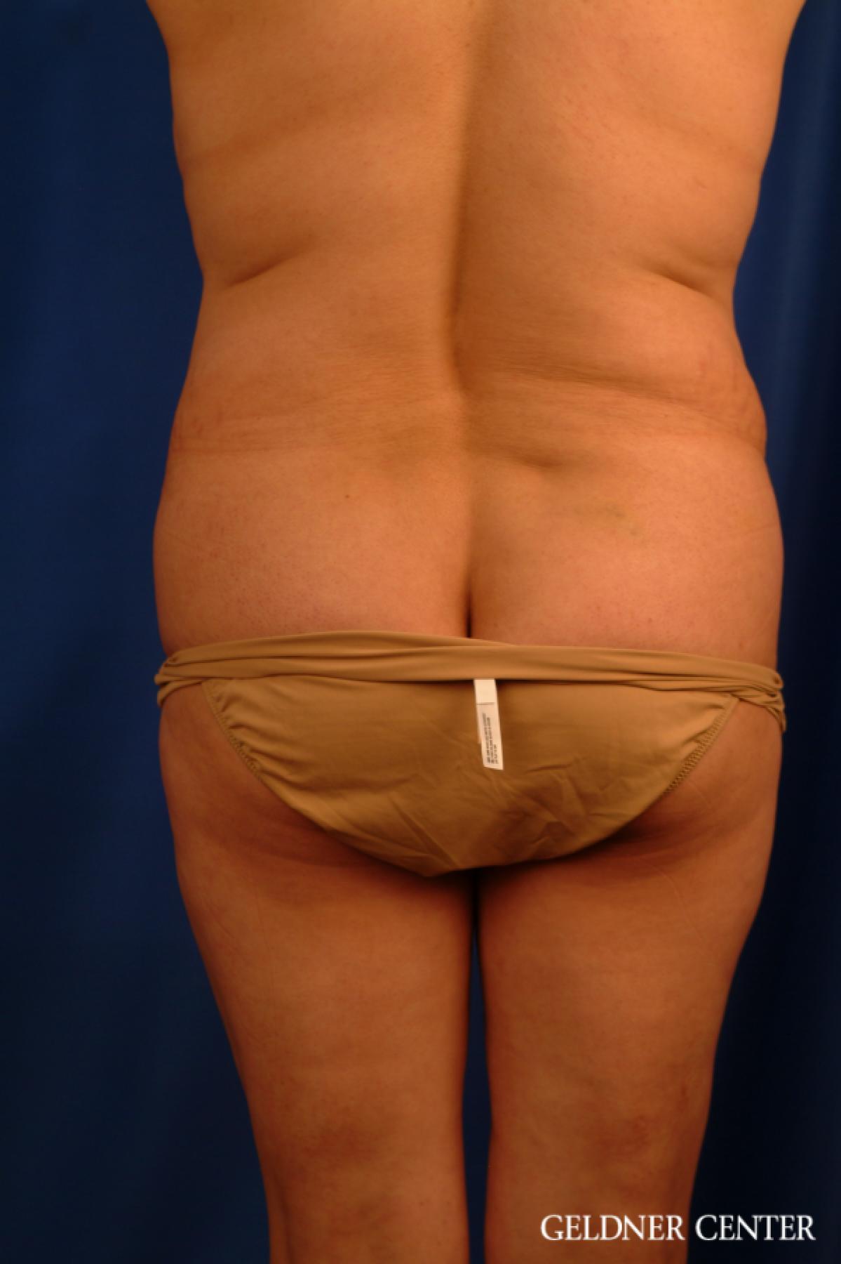 Tummy Tuck: Patient 16 - Before 4