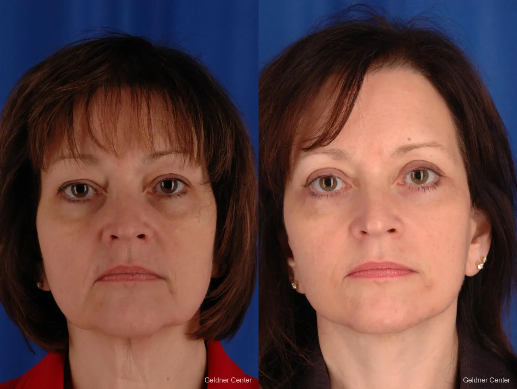 Neck Lift: Patient 2 - Before and After 