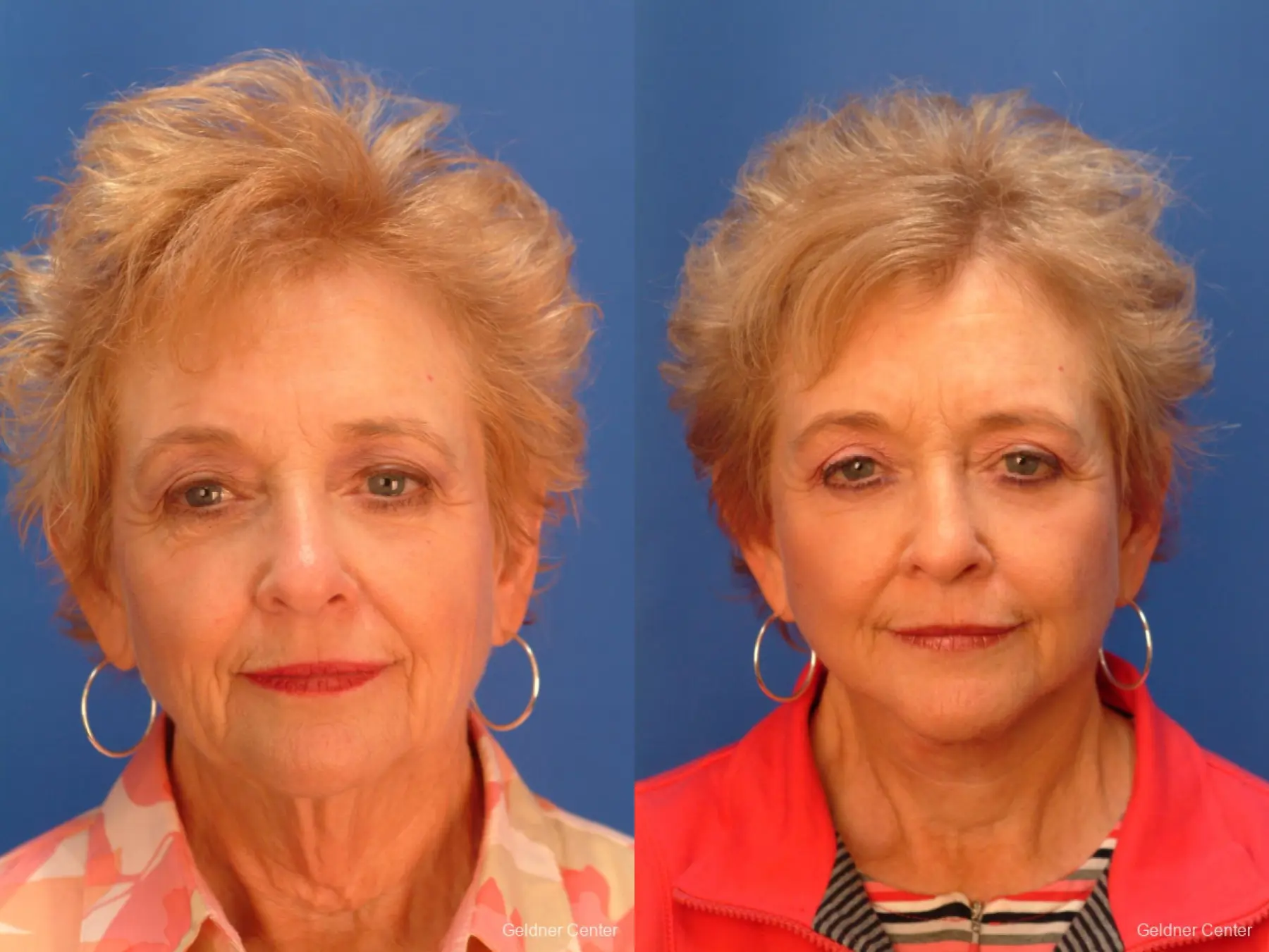 Neck Lift: Patient 5 - Before and After 