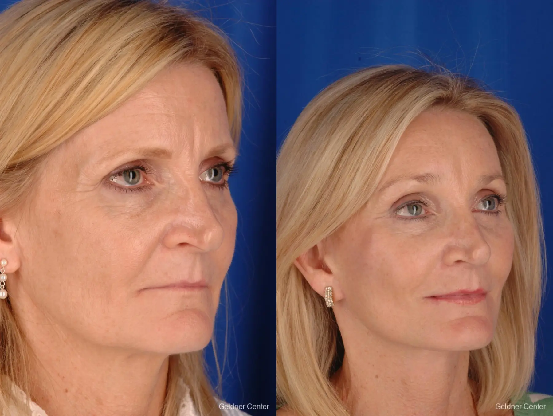 Neck Lift: Patient 3 - Before and After 3