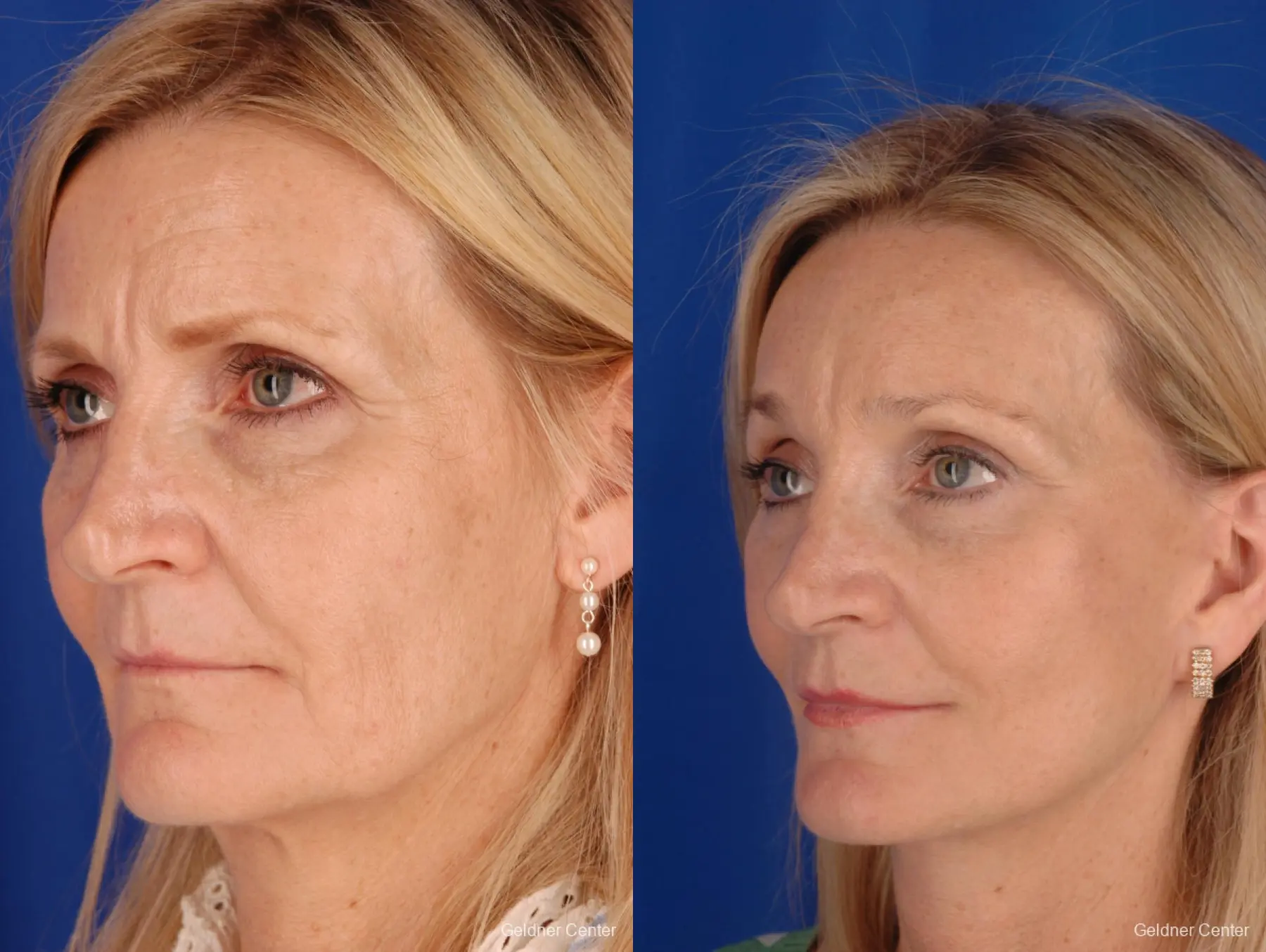 Neck Lift: Patient 3 - Before and After 4