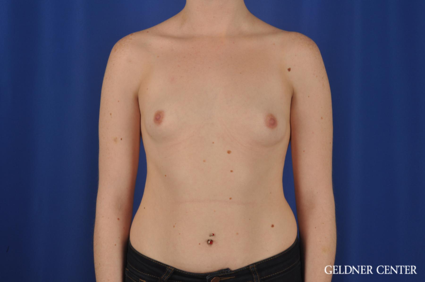 Breast Augmentation: Patient 138 - Before 1