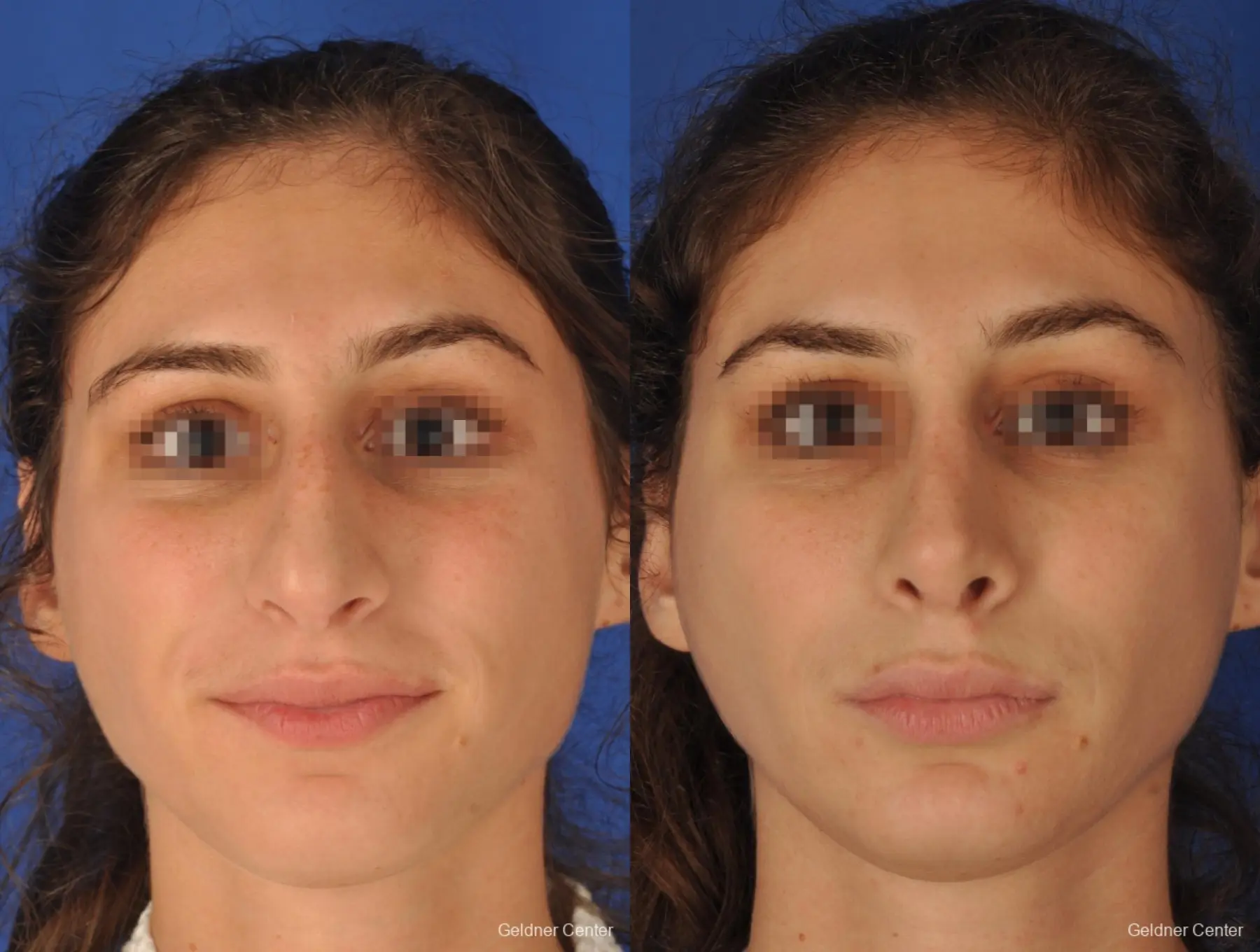 Rhinoplasty: Patient 4 - Before and After 1