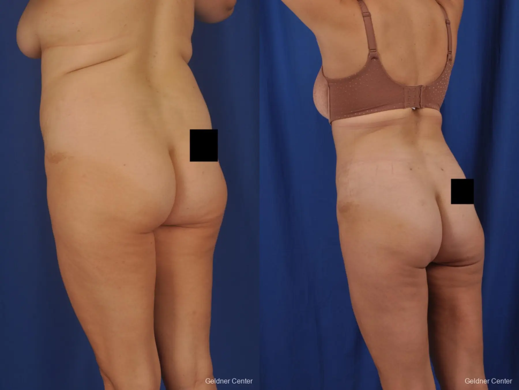 Tummy Tuck: Patient 37 - Before and After 5