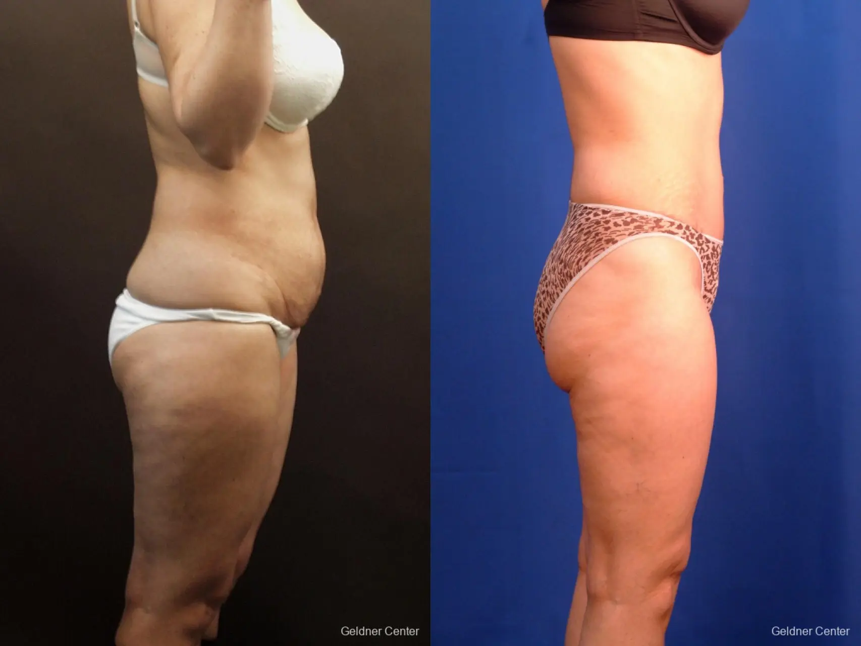 Tummy Tuck: Patient 8 - Before and After 3