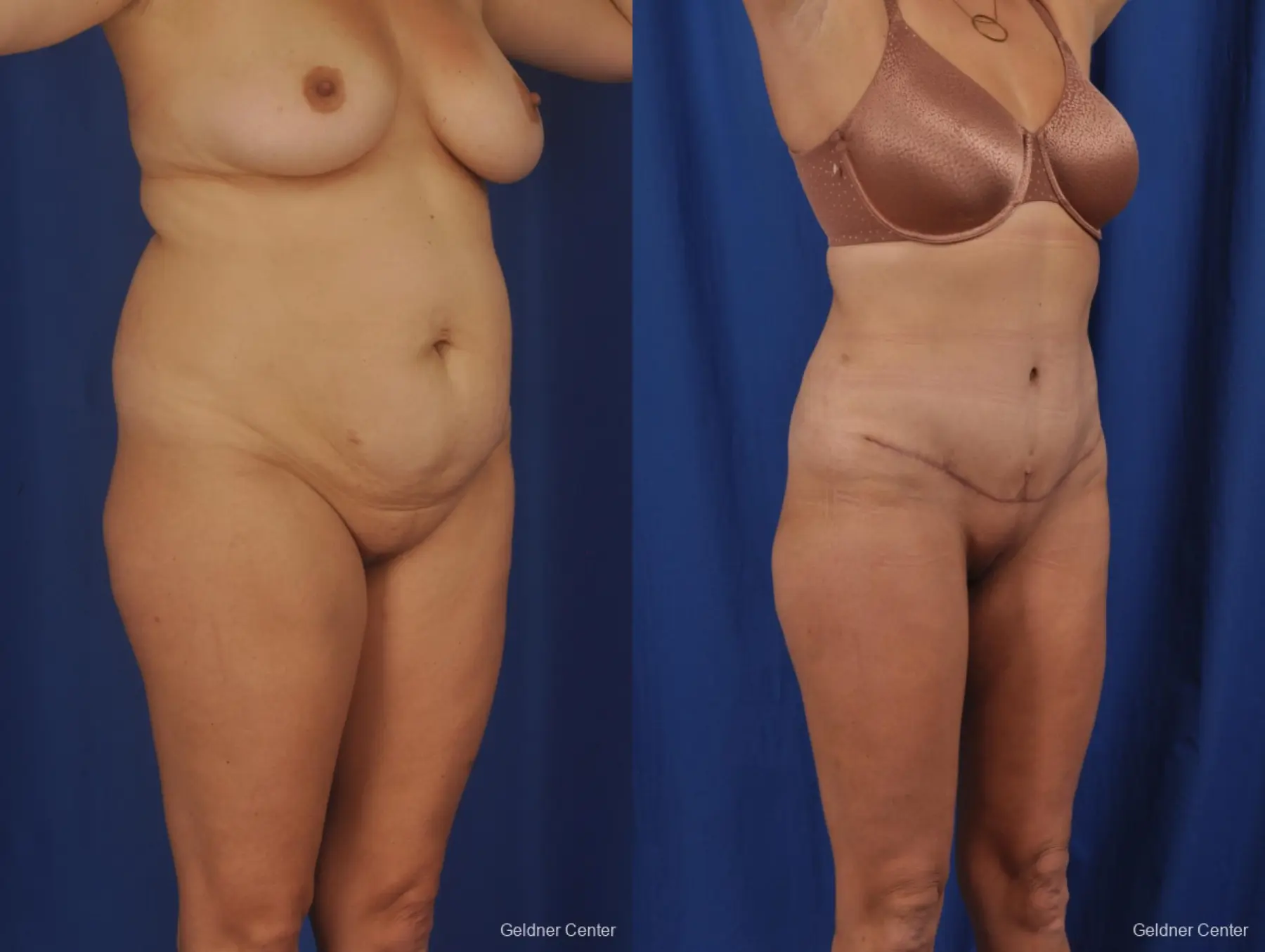 Tummy Tuck: Patient 37 - Before and After 2