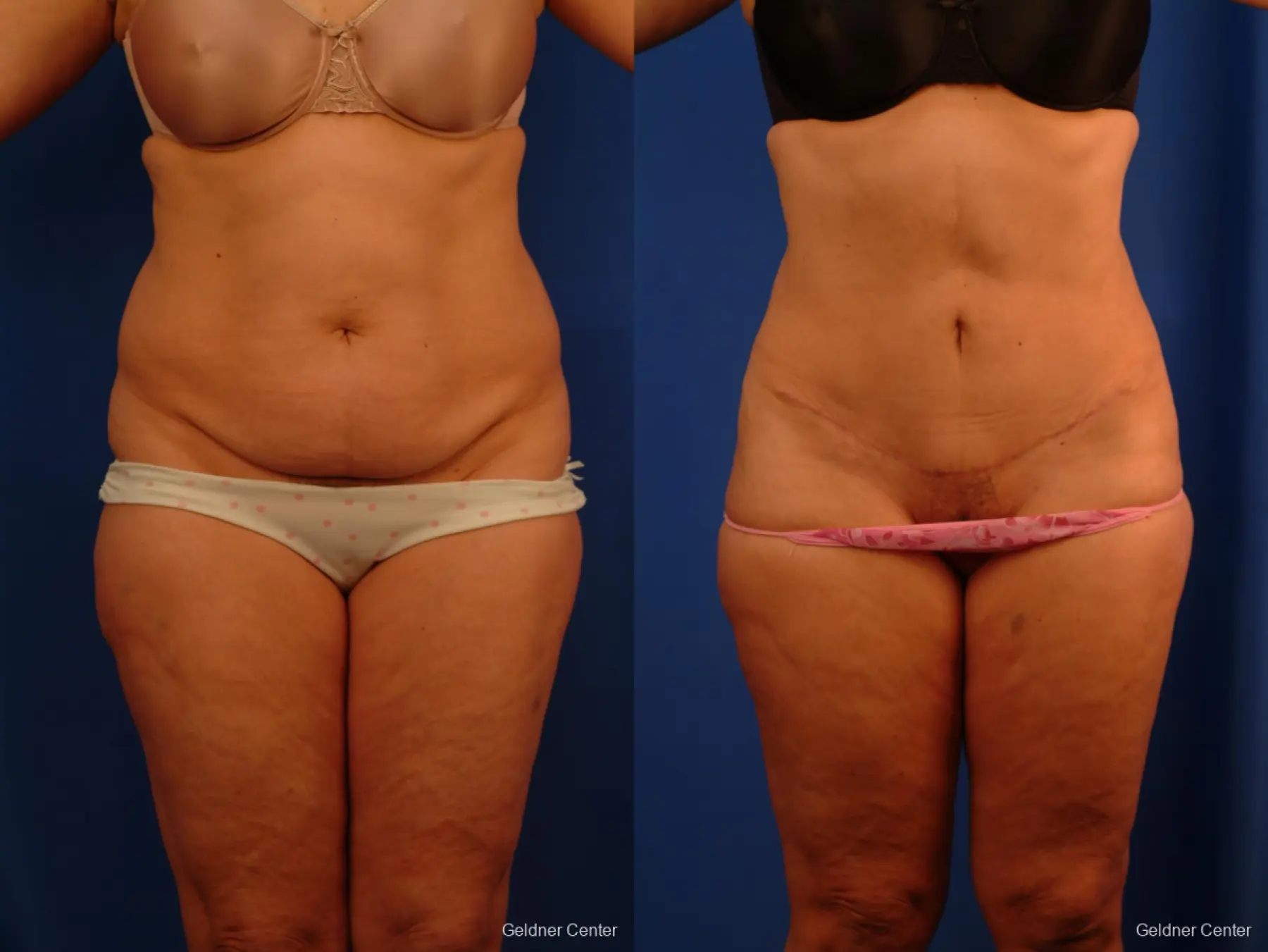 Tummy Tuck: Patient 9 - Before and After 