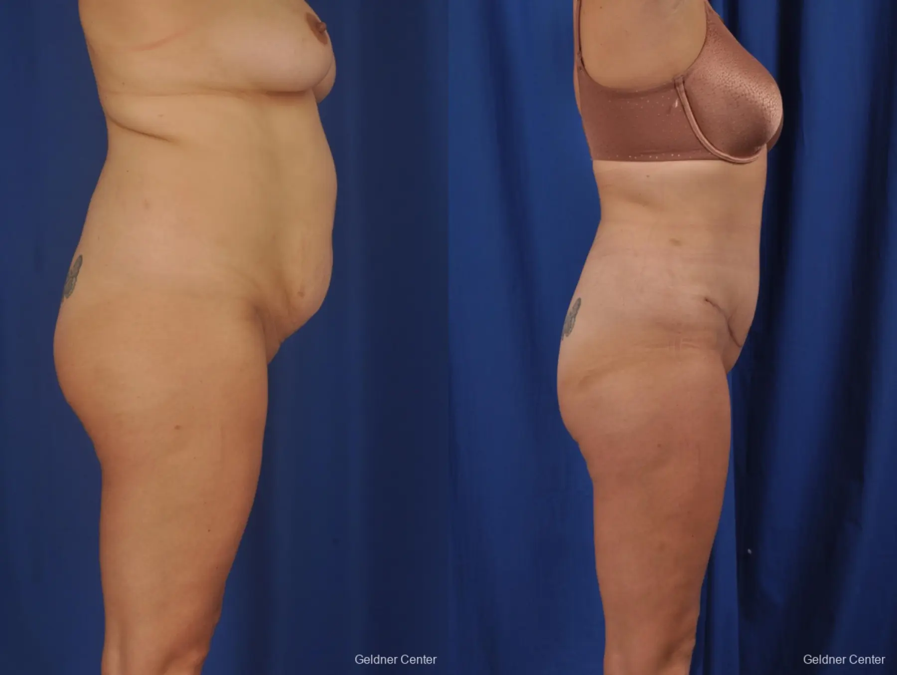 Tummy Tuck: Patient 37 - Before and After 3