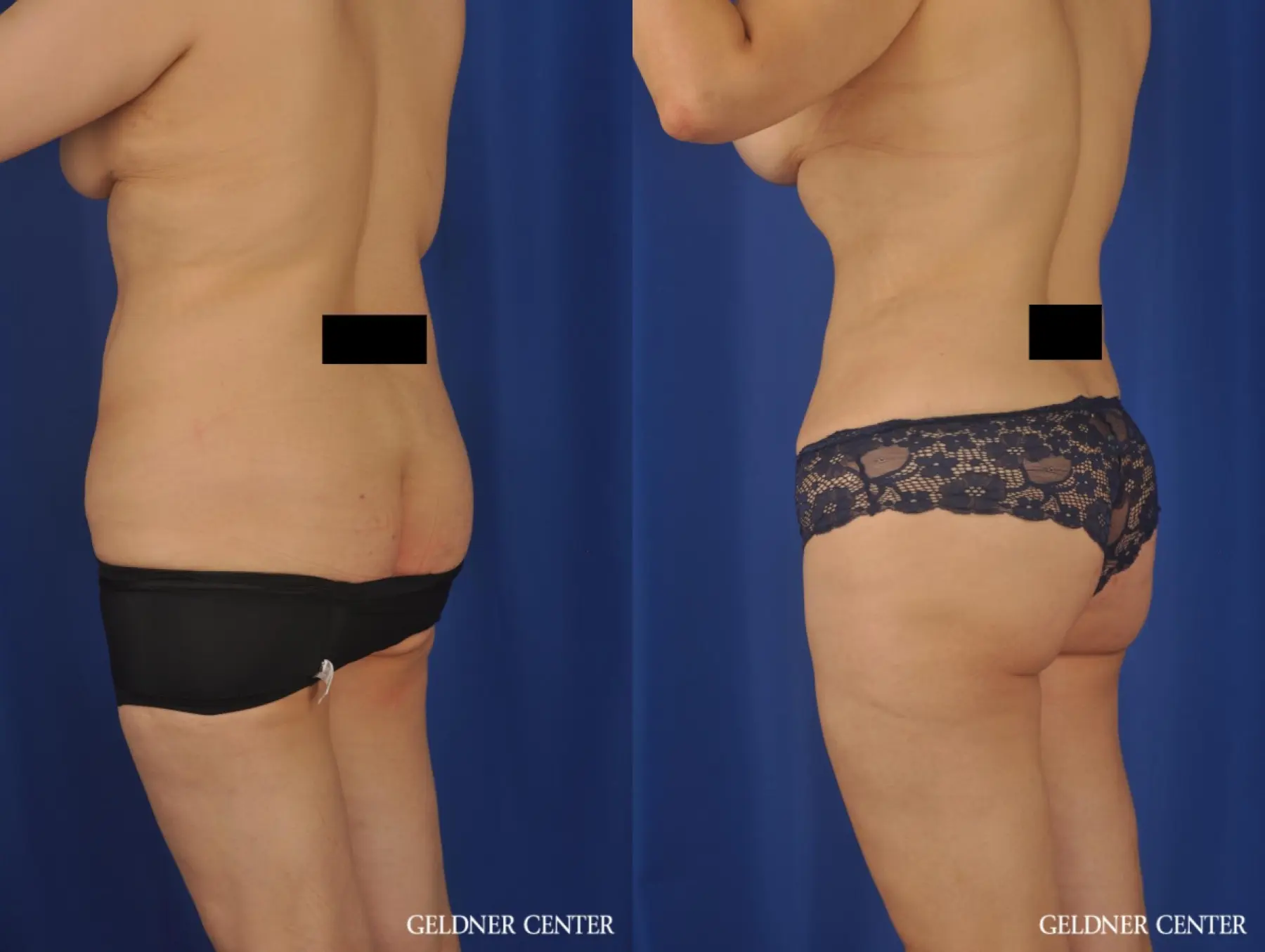 VASER® Lipo: Patient 13 - Before and After 5