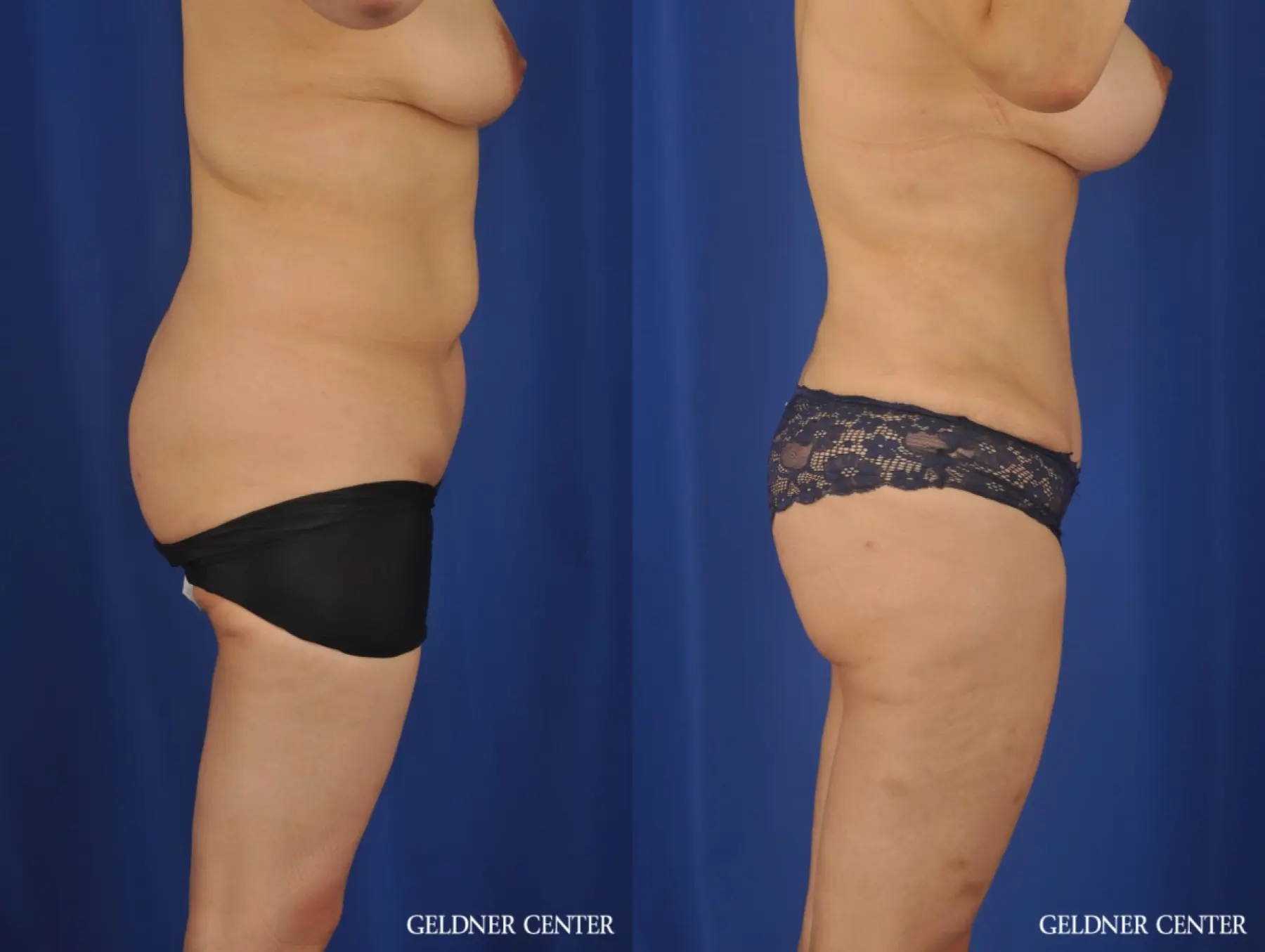 VASER® Lipo: Patient 13 - Before and After 3