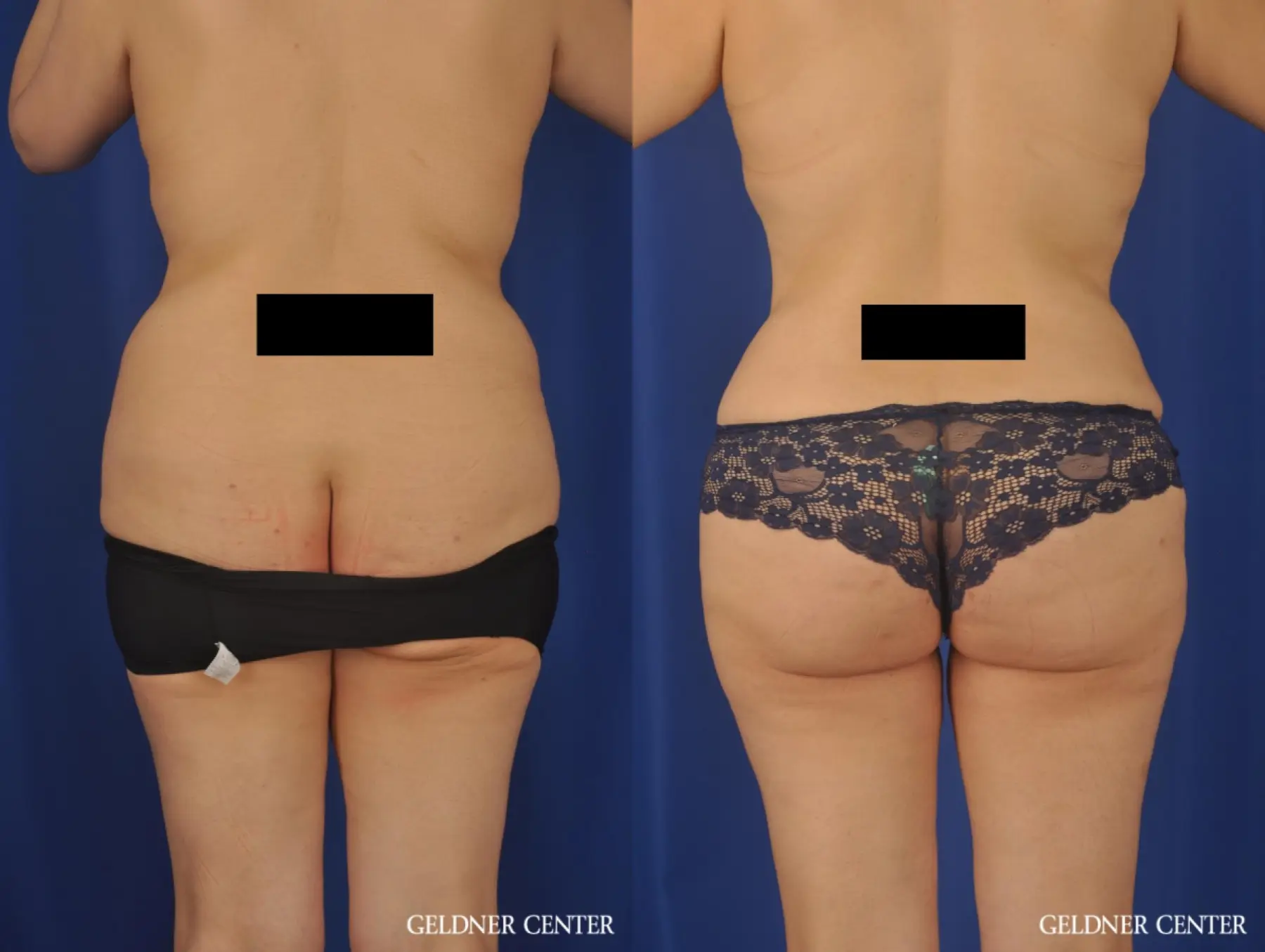 VASER® Lipo: Patient 13 - Before and After 4