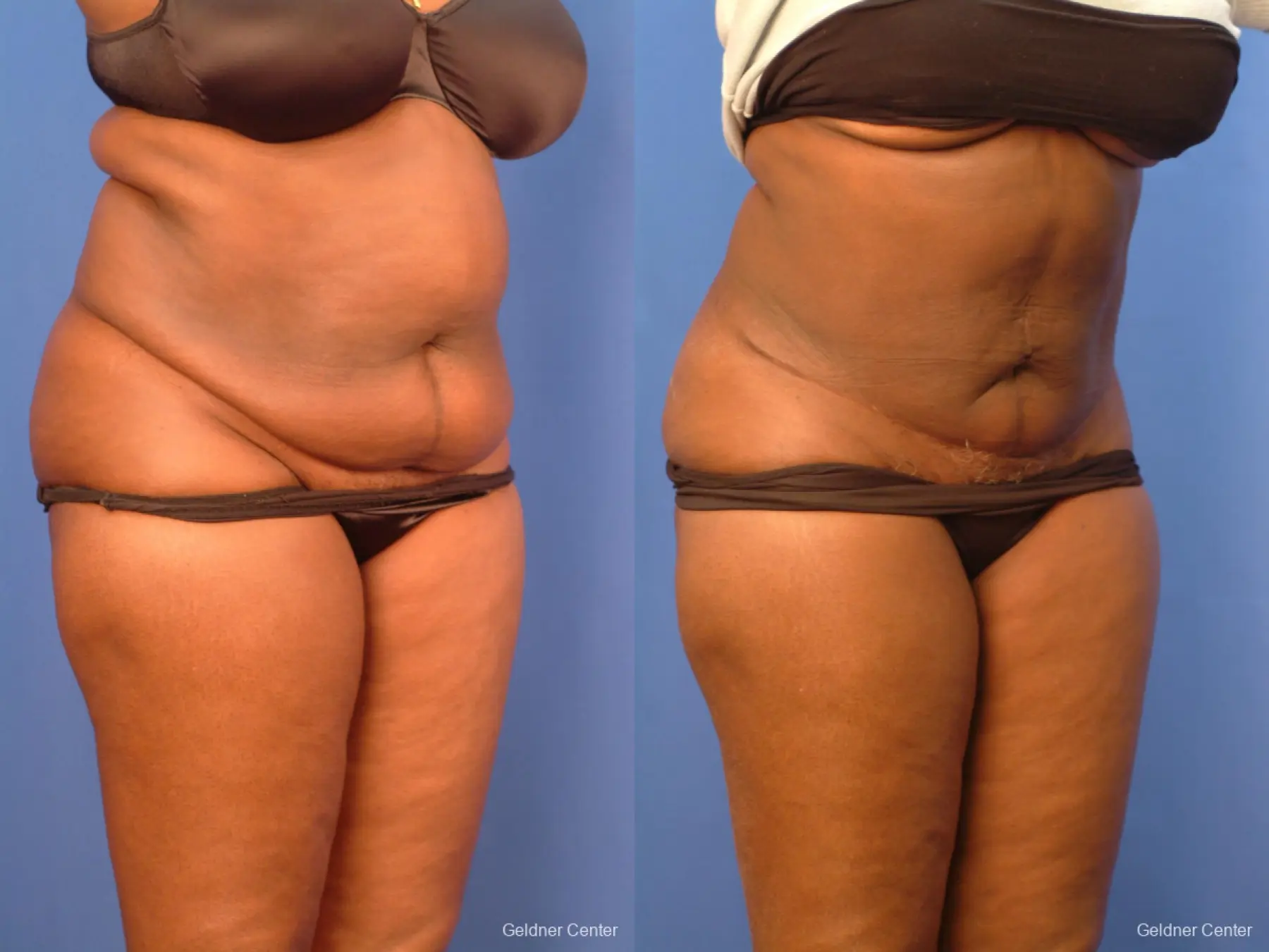 Vaser lipo patient 2540 before and after photos - Before and After 3