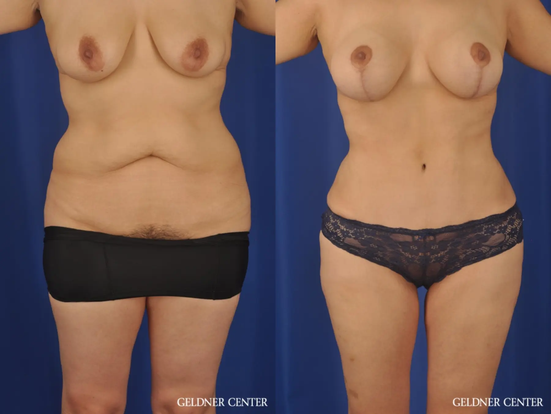 VASER® Lipo: Patient 13 - Before and After 1