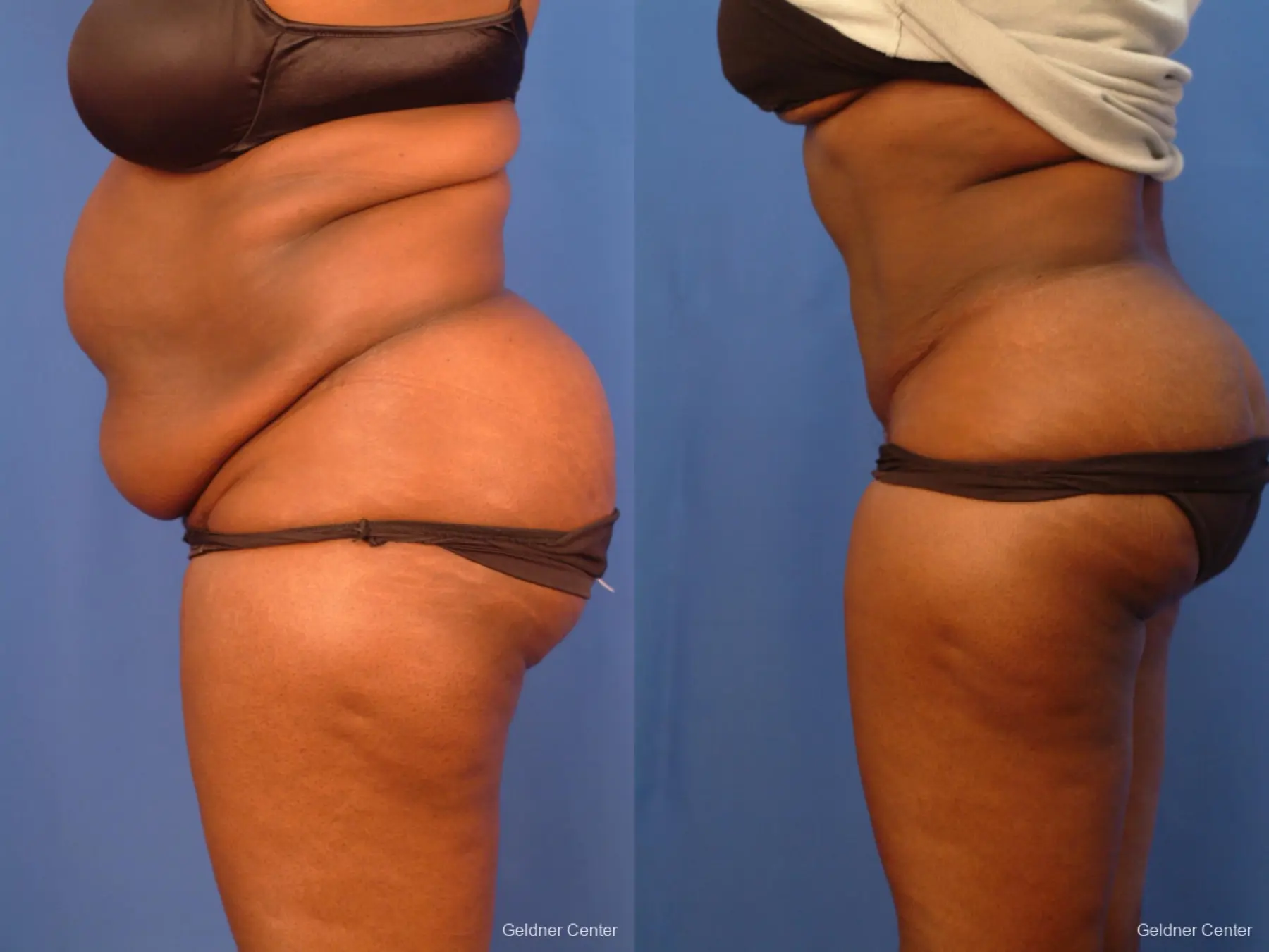 Vaser lipo patient 2540 before and after photos - Before and After 4