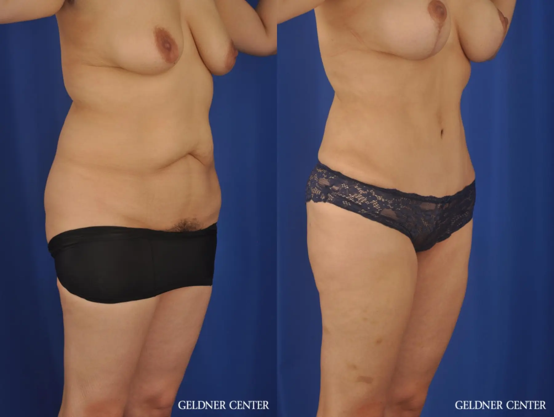 VASER® Lipo: Patient 13 - Before and After 2