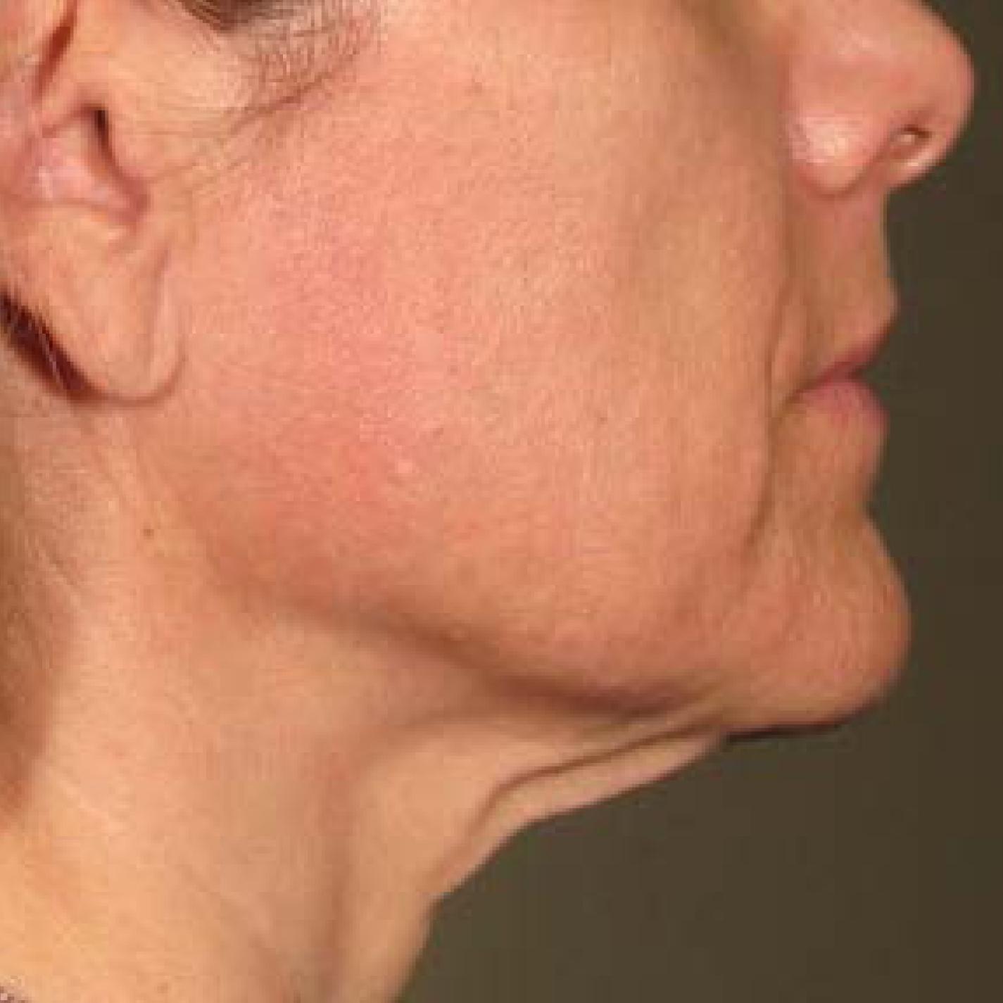 Ultherapy® - Chin: Patient 31 - After 1