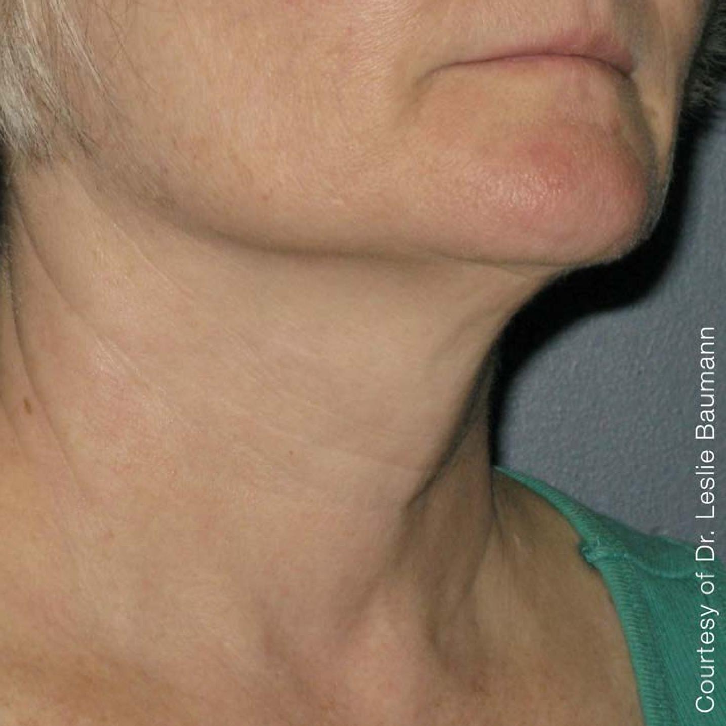 Ultherapy® - Neck: Patient 2 - After 1