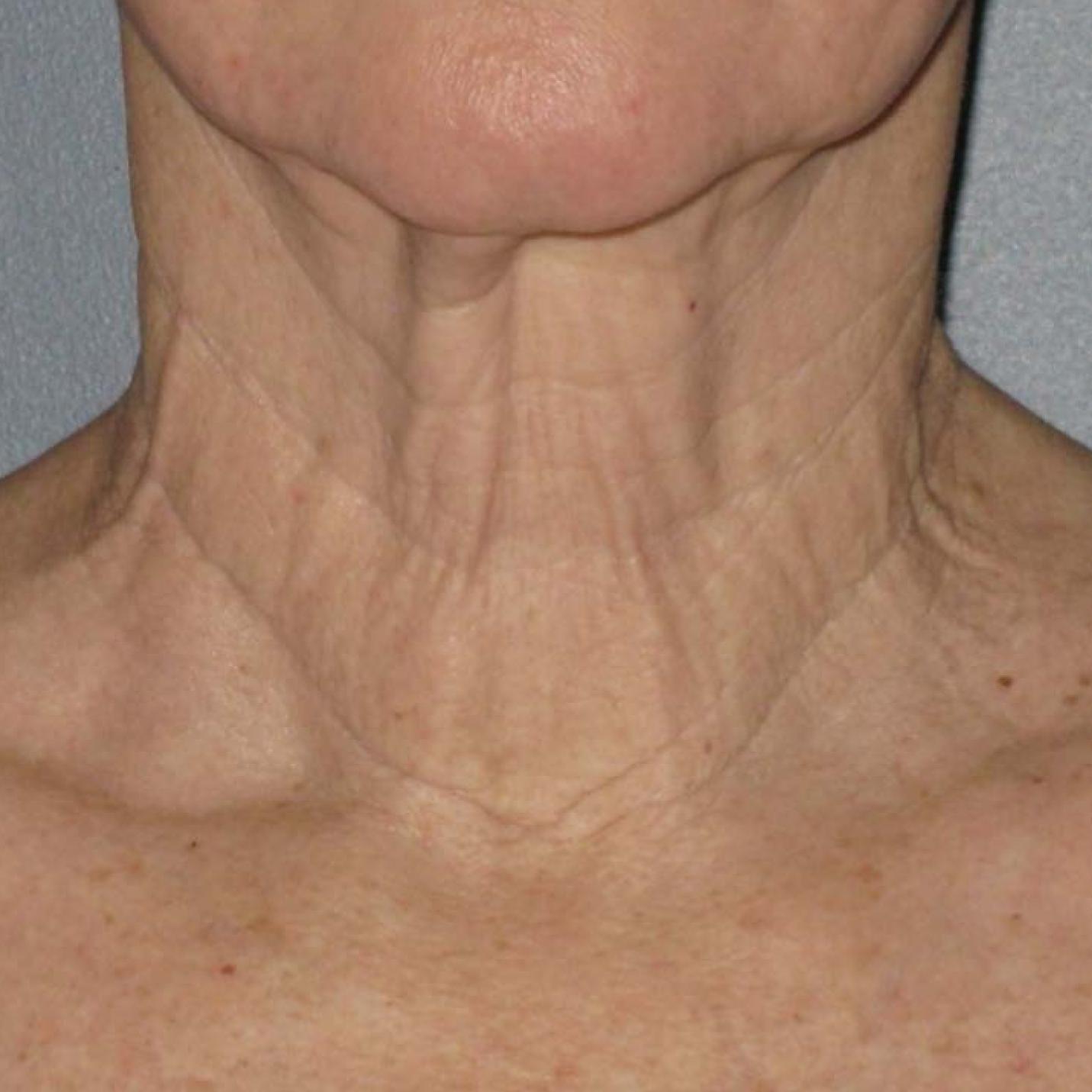 Ultherapy® - Neck: Patient 6 - Before 