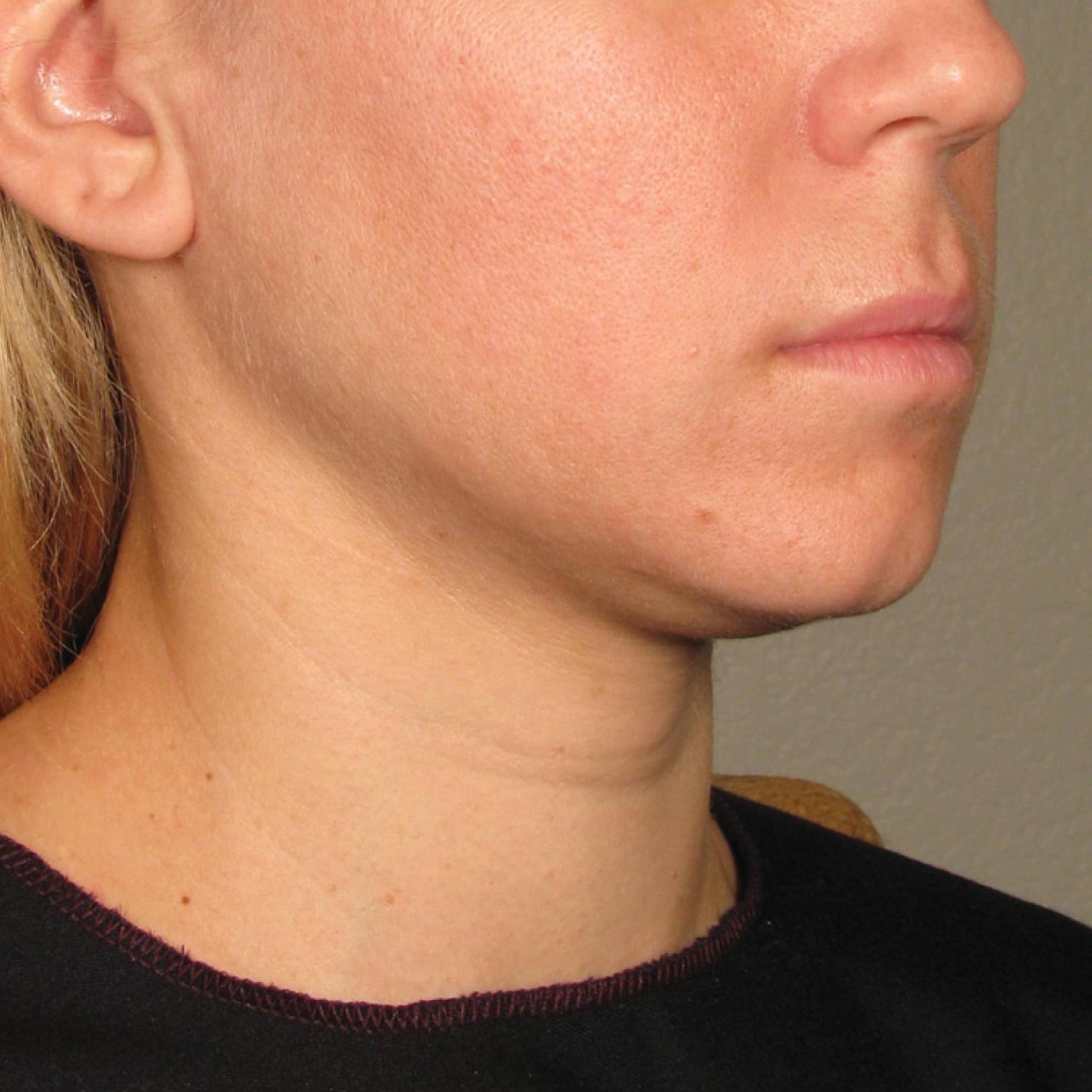 Ultherapy® - Chin: Patient 23 - Before 1