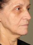Ultherapy® - Face: Patient 1 - After 