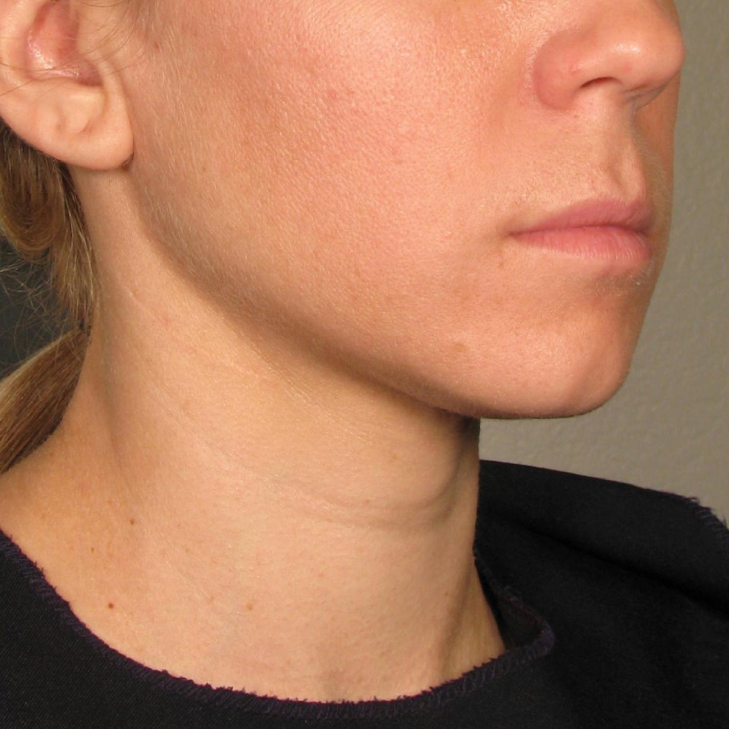 Ultherapy® - Chin: Patient 23 - After 1