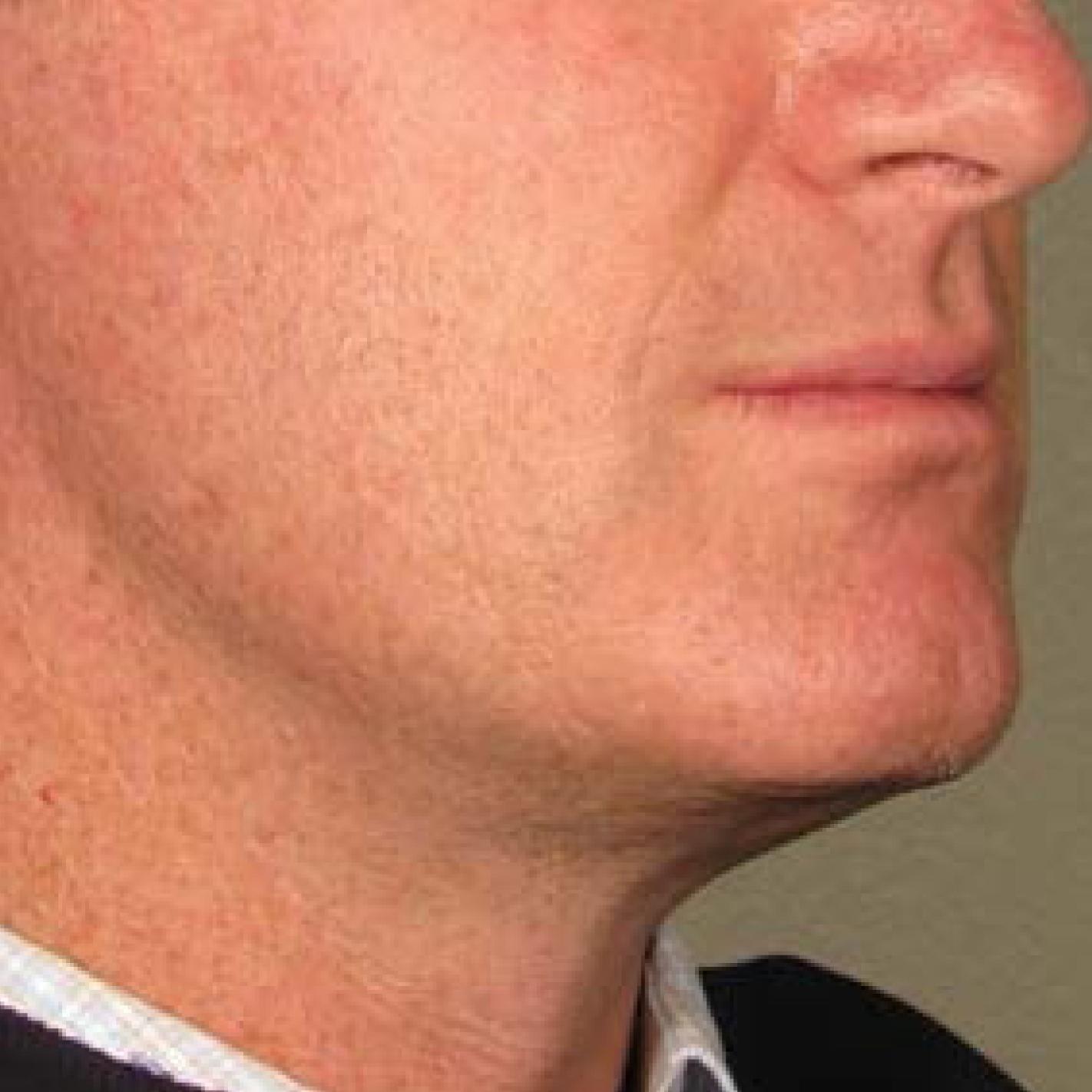 Ultherapy® - Chin: Patient 19 - After 1
