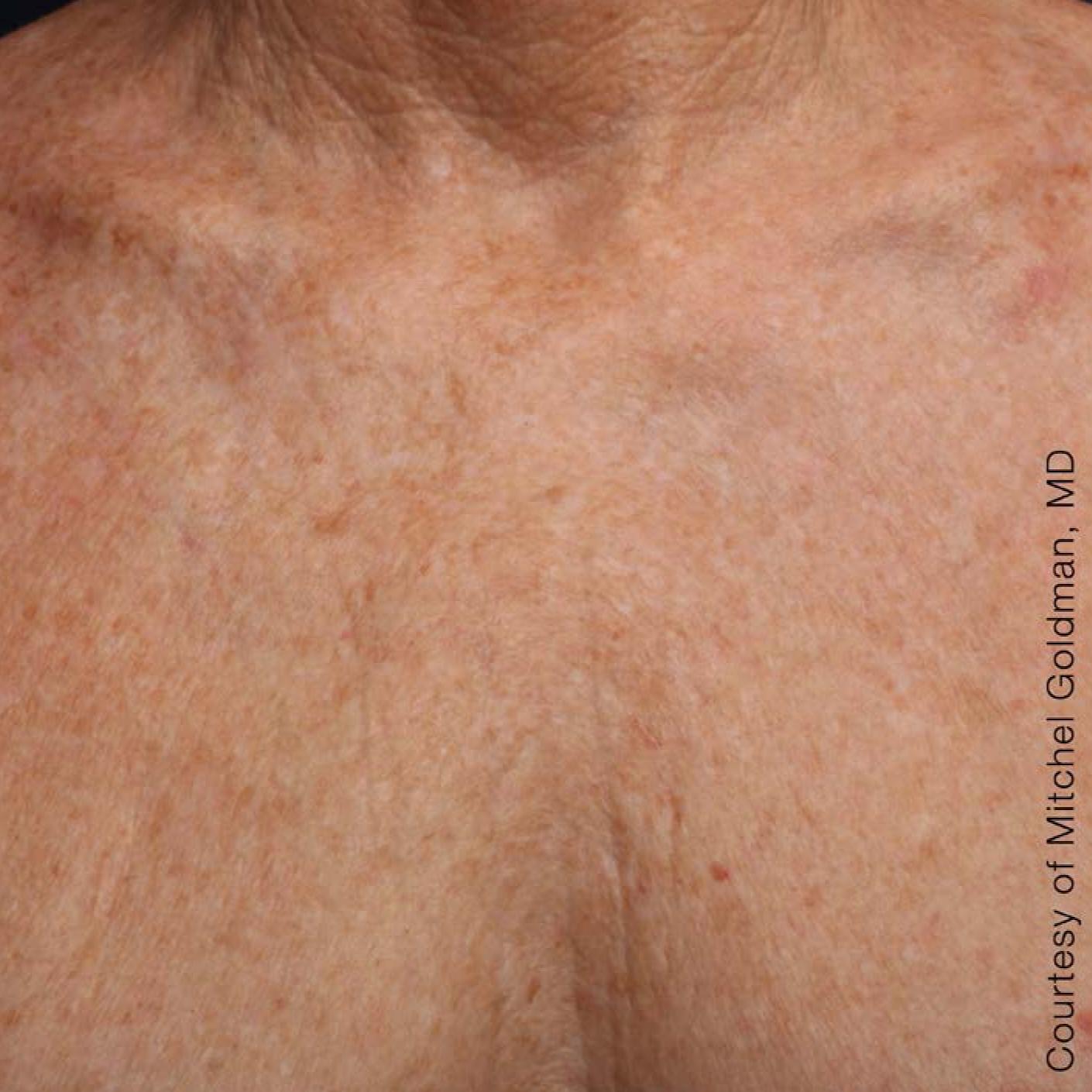 Ultherapy® - Décolletage: Patient 15 - After 1