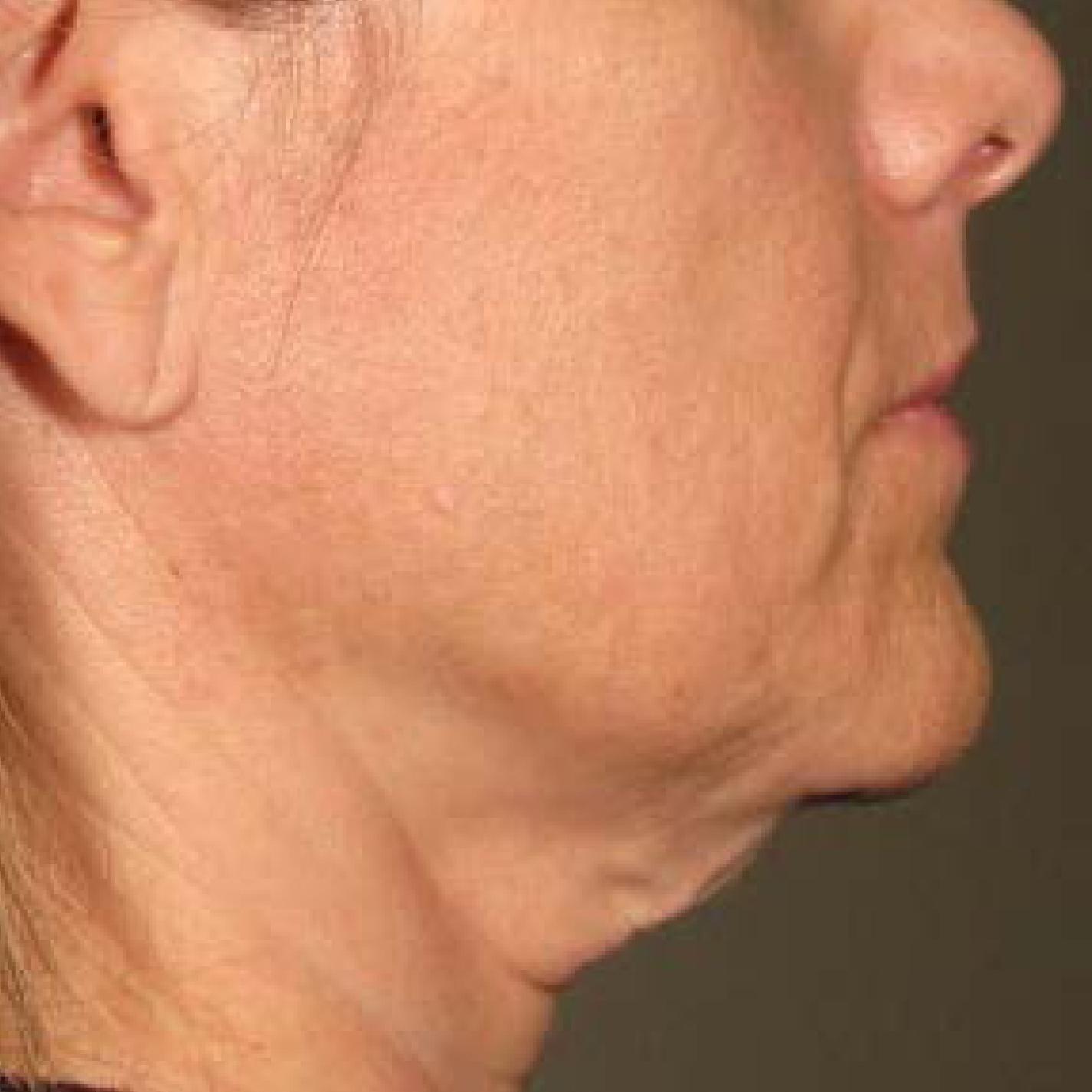Ultherapy® - Chin: Patient 31 - Before 1