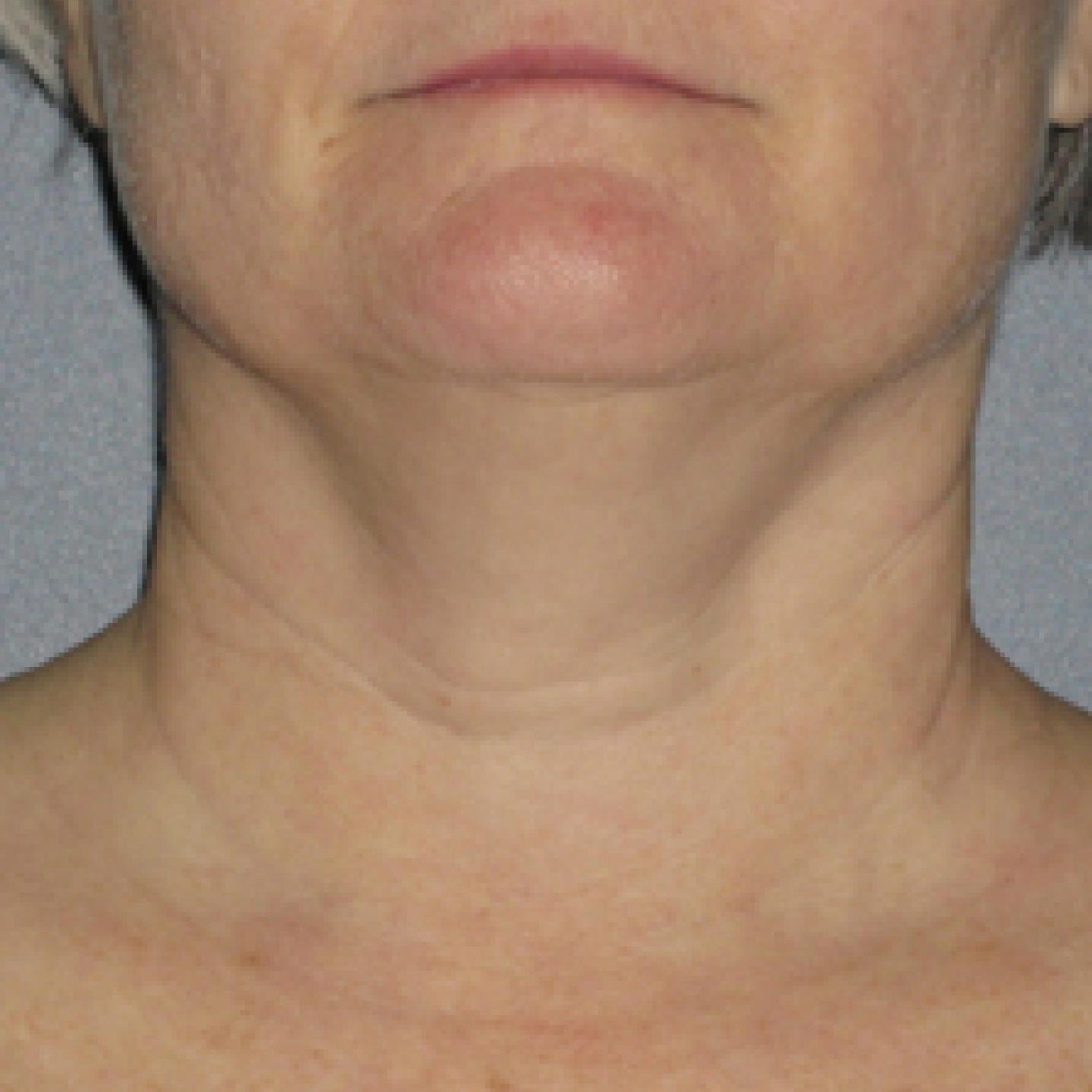 Ultherapy® - Neck: Patient 1 - Before 