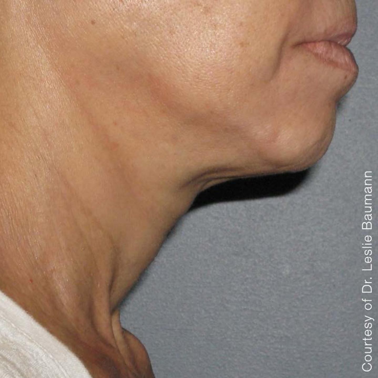 Ultherapy® - Neck: Patient 8 - After 