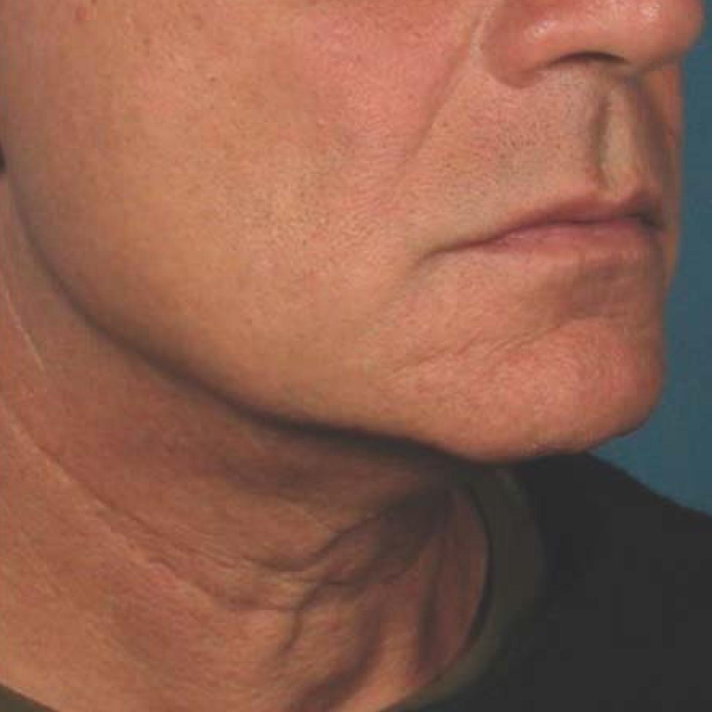 Ultherapy® - Chin: Patient 40 - After 1