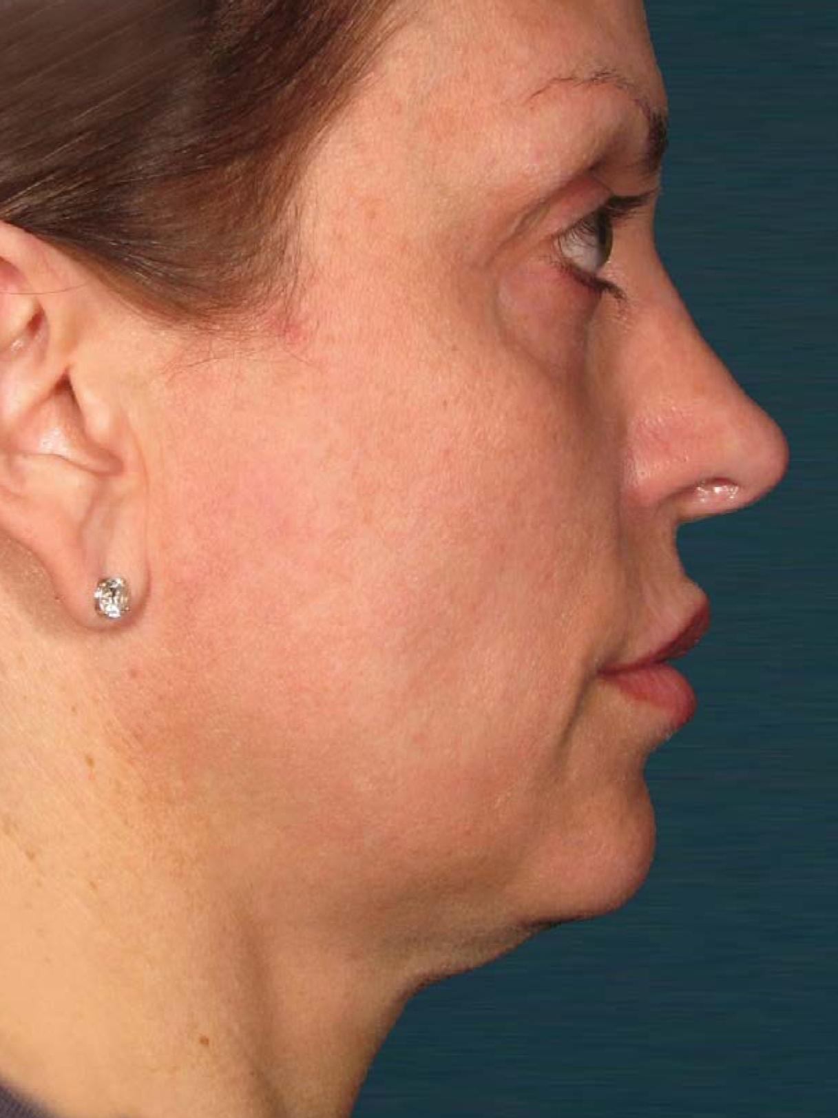 Ultherapy® - Face: Patient 24 - Before 1