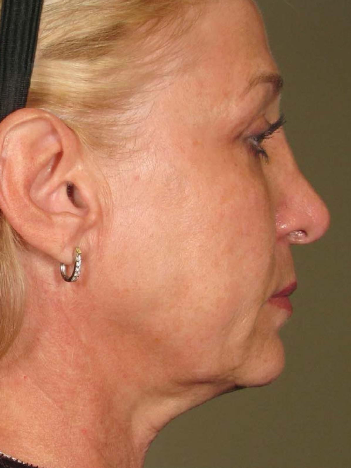 Ultherapy® - Face: Patient 14 - After 1