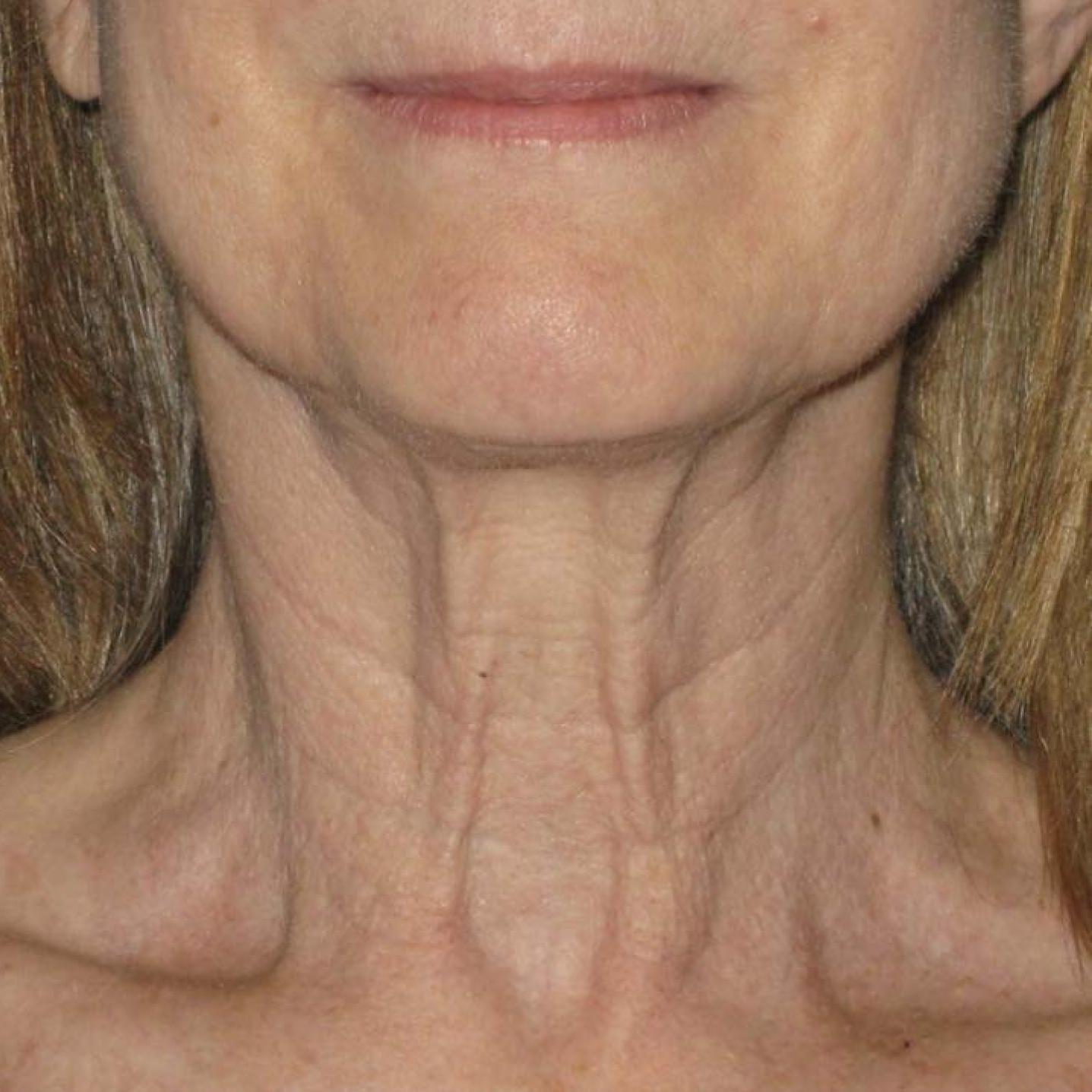 Ultherapy® - Neck: Patient 10 - Before 
