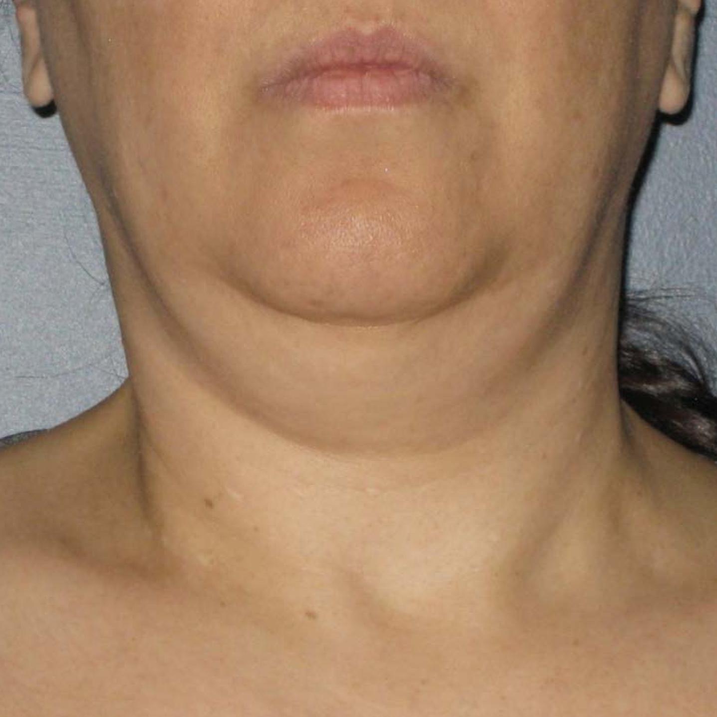 Ultherapy® - Neck: Patient 5 - Before 