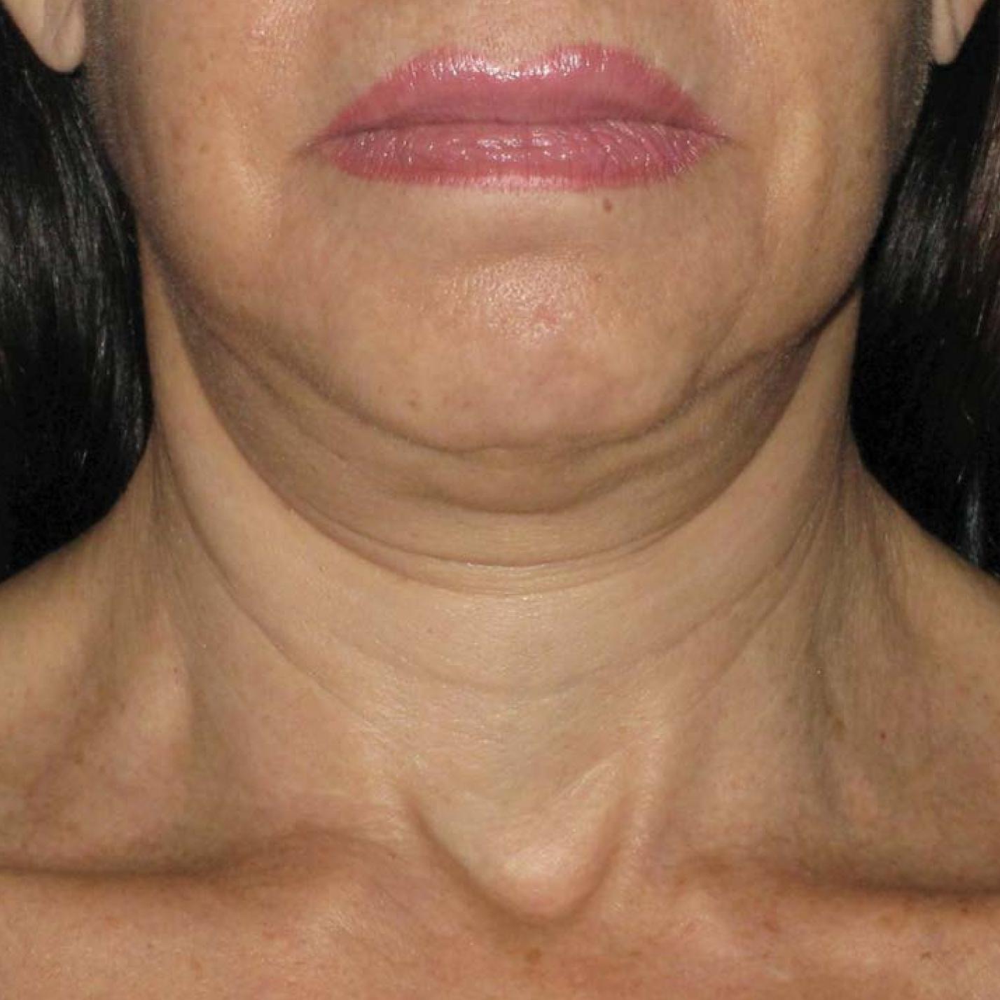 Ultherapy® - Neck: Patient 7 - Before 1
