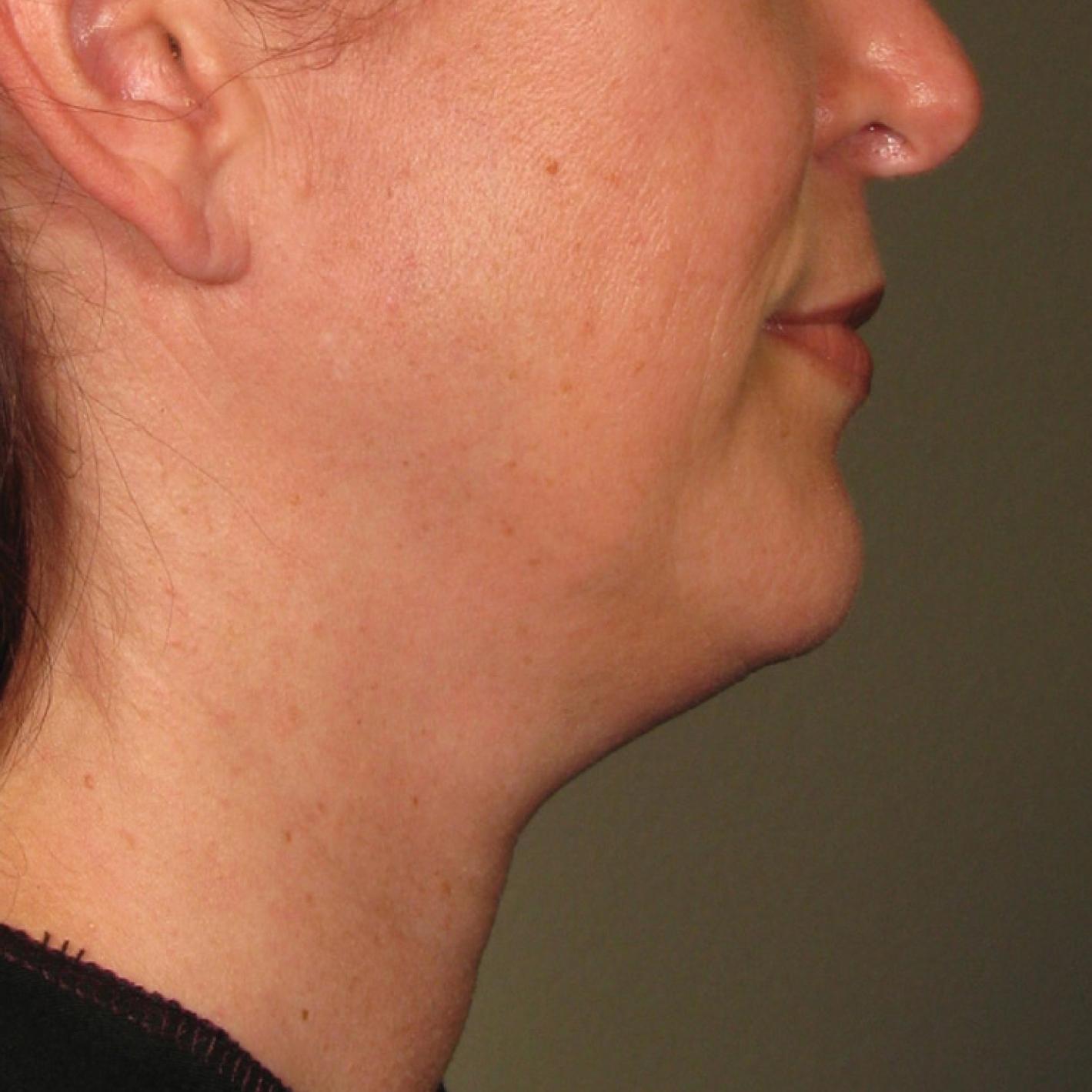 Ultherapy® - Chin: Patient 21 - Before 1
