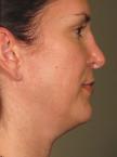 Ultherapy® - Face: Patient 9 - Before 