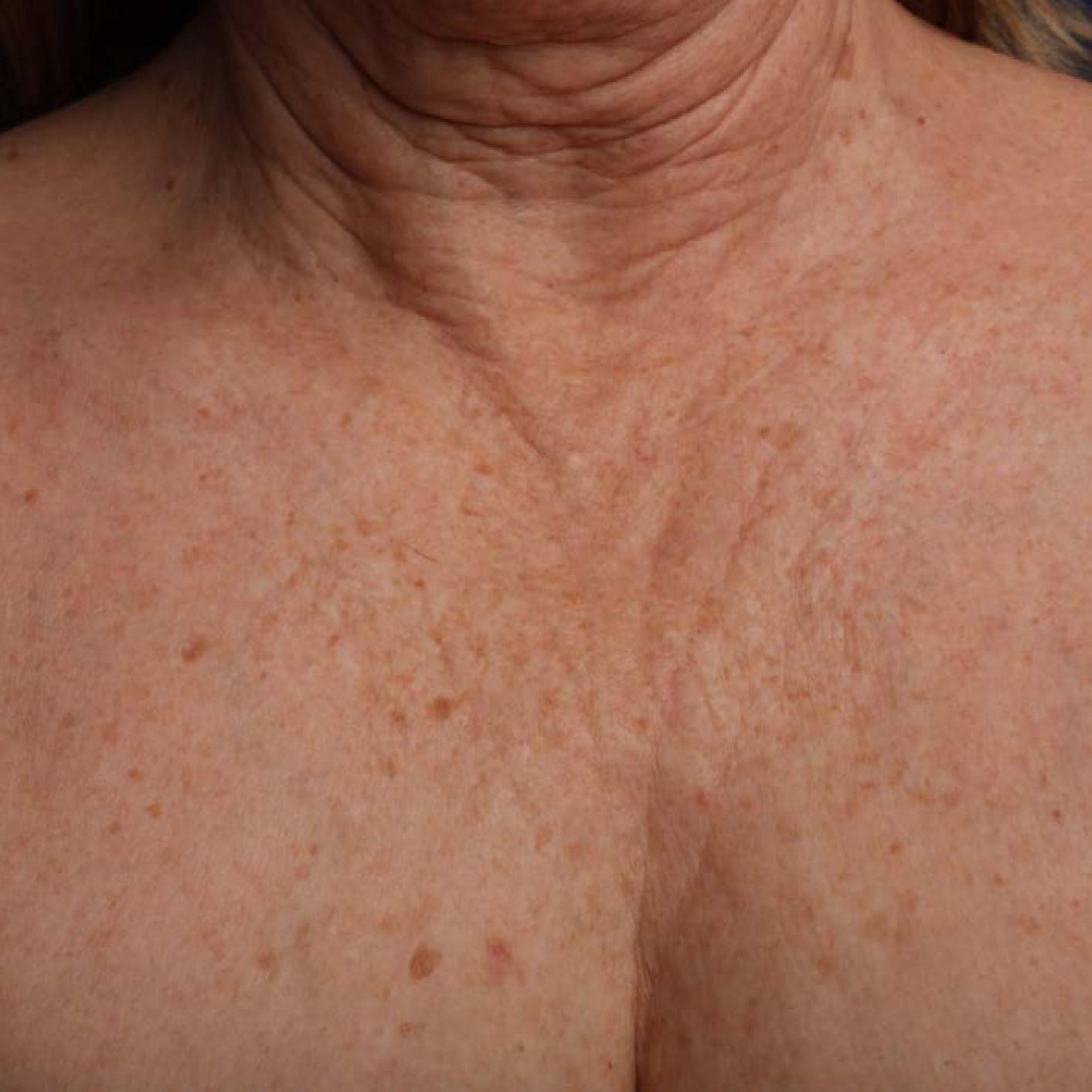 Ultherapy® - Décolletage: Patient 17 - Before 1
