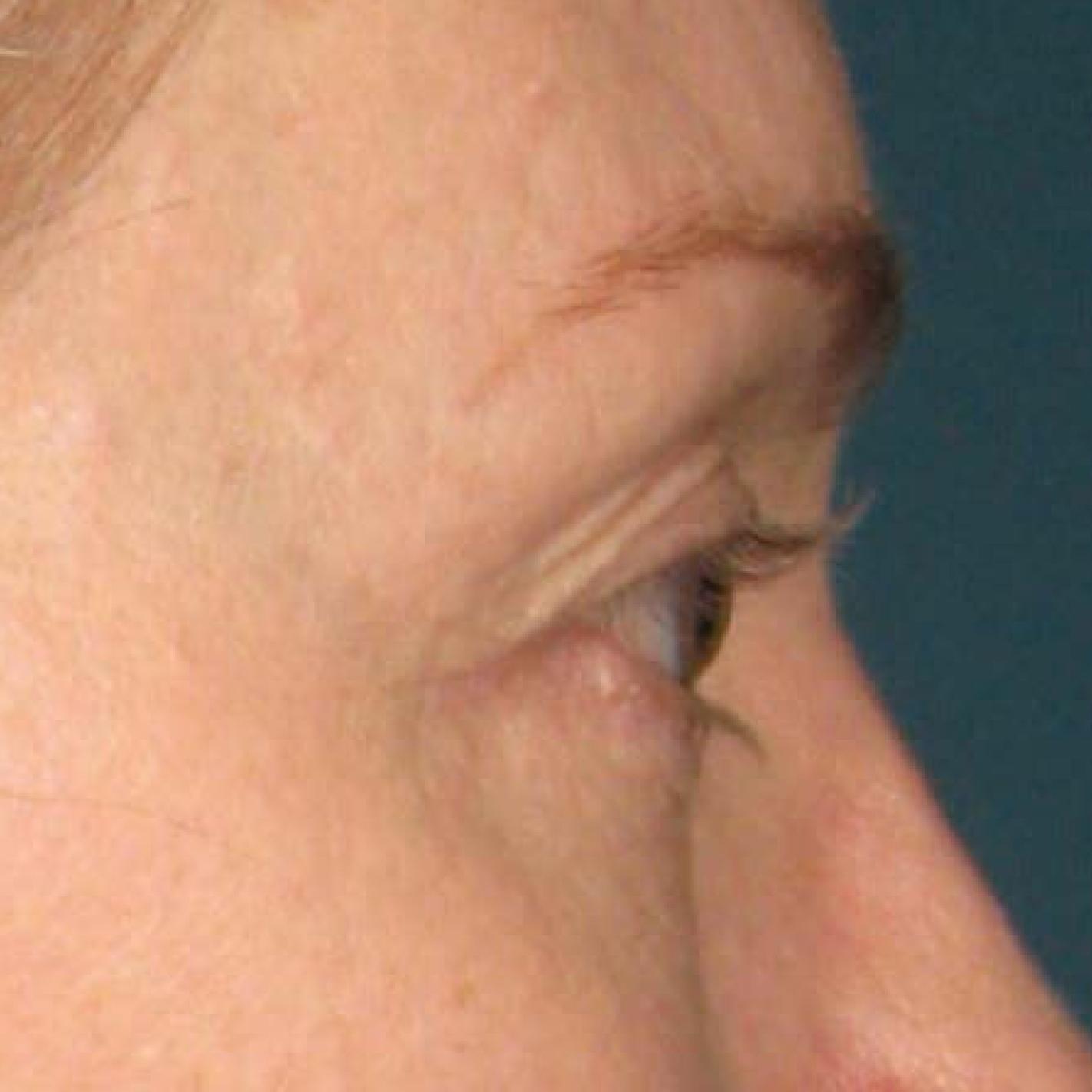 Ultherapy® - Brow: Patient 5 - After 1