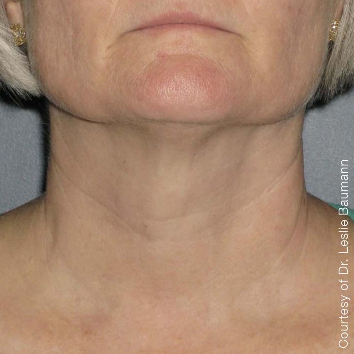Ultherapy® - Neck: Patient 1 - After 