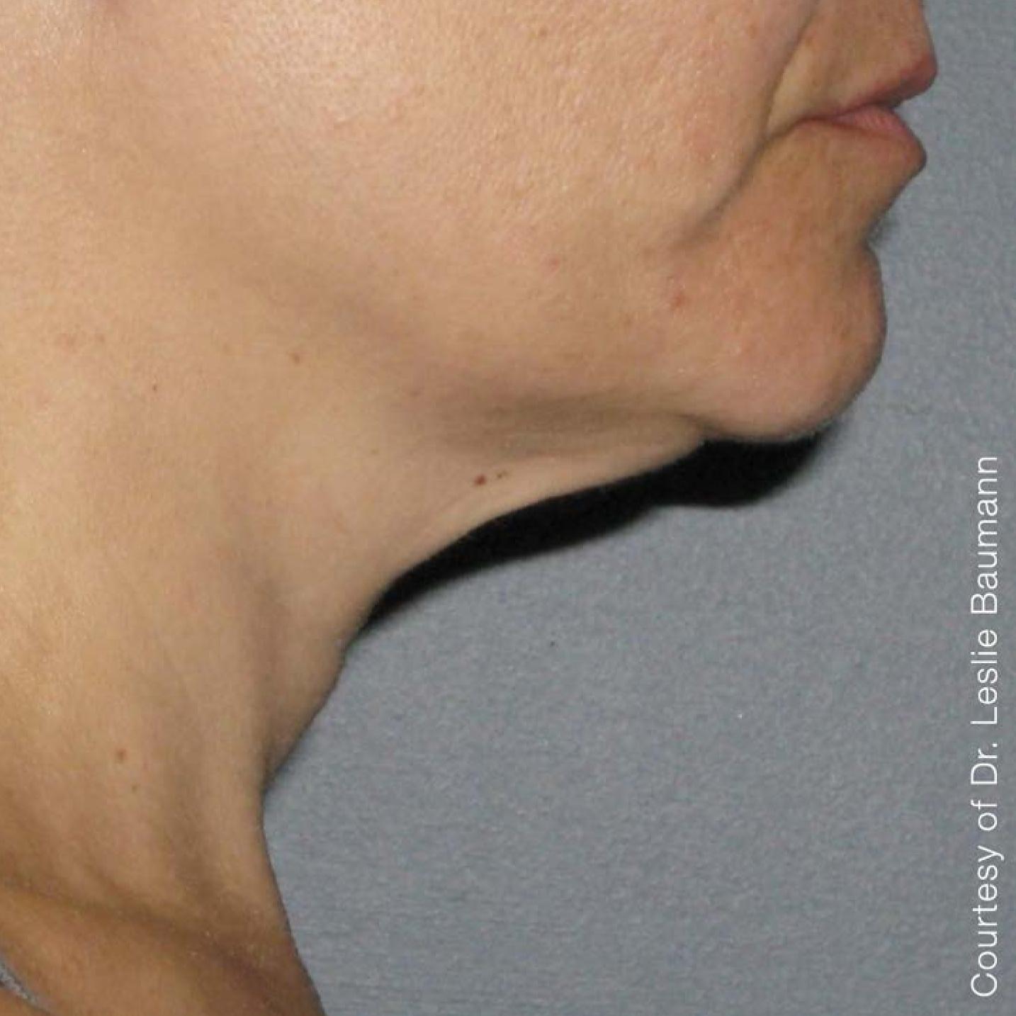 Ultherapy® - Neck: Patient 4 - After 