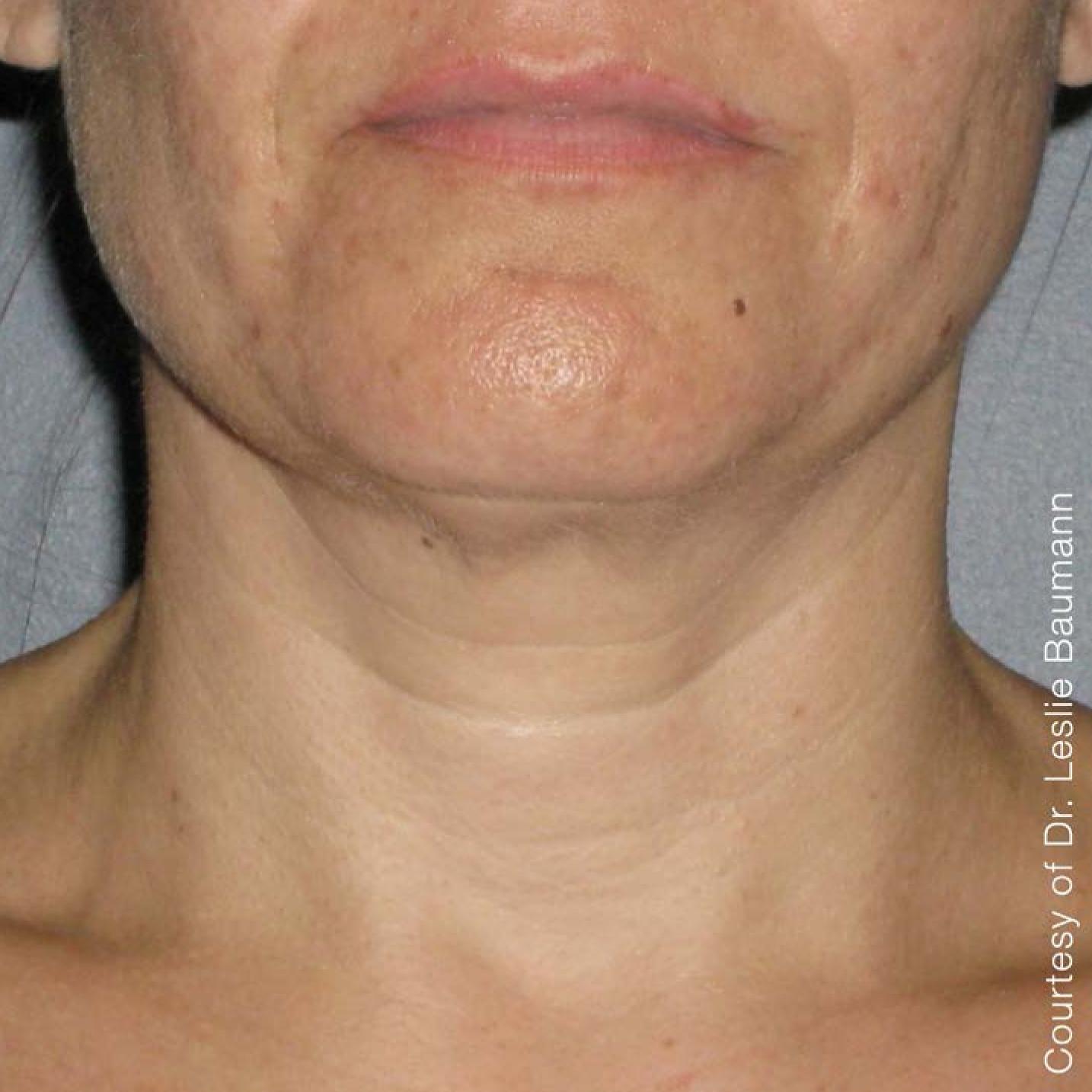 Ultherapy® - Neck: Patient 3 - After 