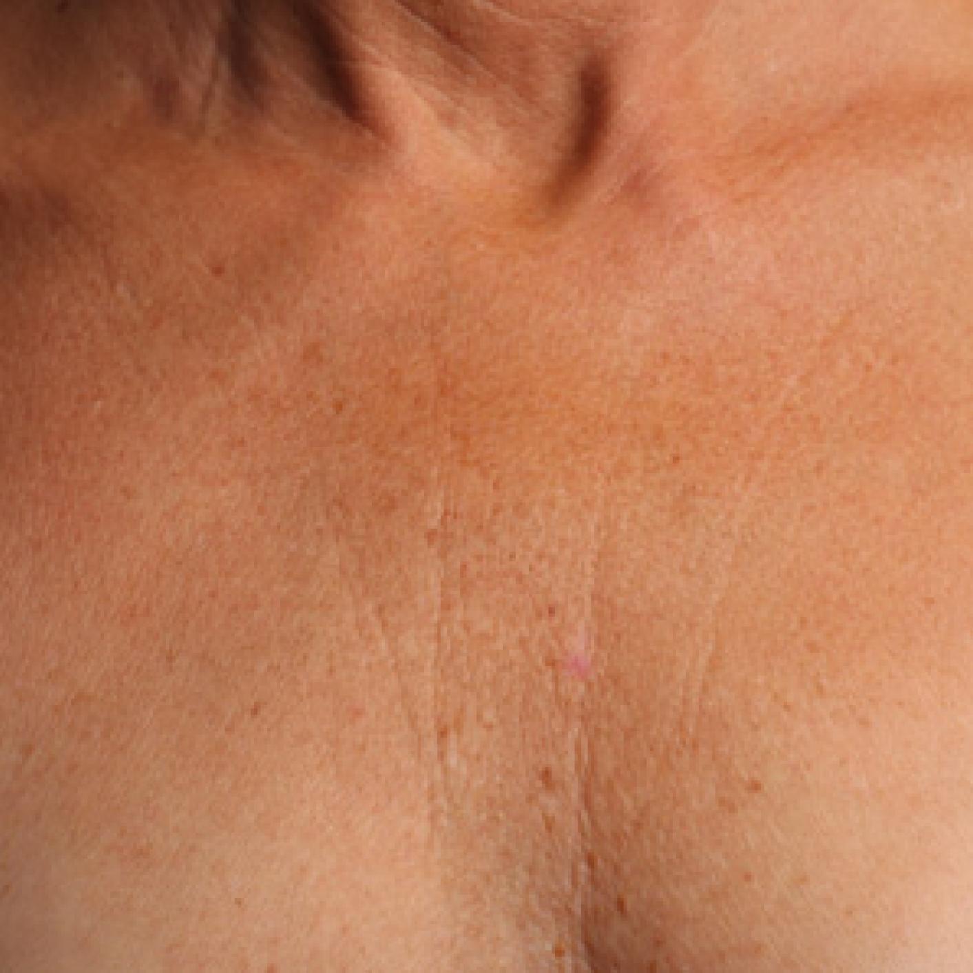 Ultherapy® - Décolletage: Patient 10 - Before 1
