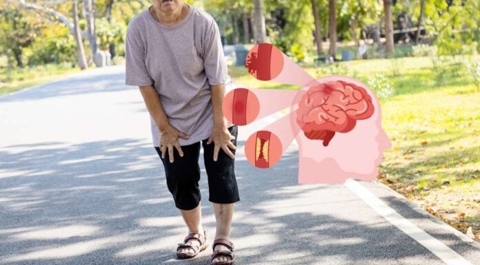 Sarcopenia Induce Stroke Heart Disease