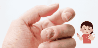 Abnormal Nail